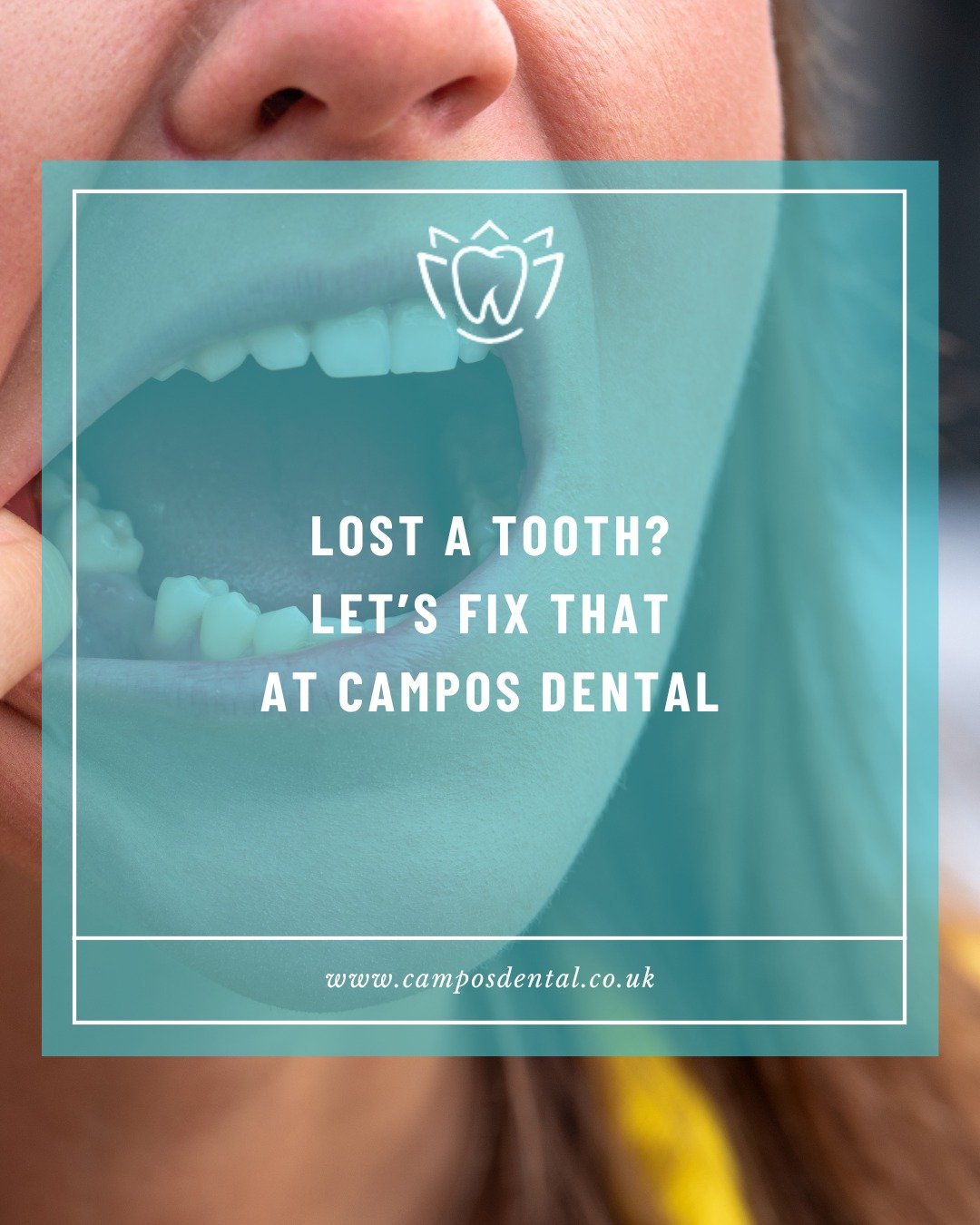 Missing teeth can be a hassle, but you don&rsquo;t have to live with the gap. At Campos Dental, we offer tailored solutions to restore your smile and keep things working smoothly.

Here&rsquo;s what you can expect:

🩵 Dental Implants: The top choice