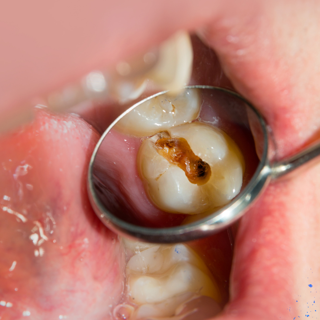 π¦· Emergency Tooth Extraction in Edgware: What You Need to Know