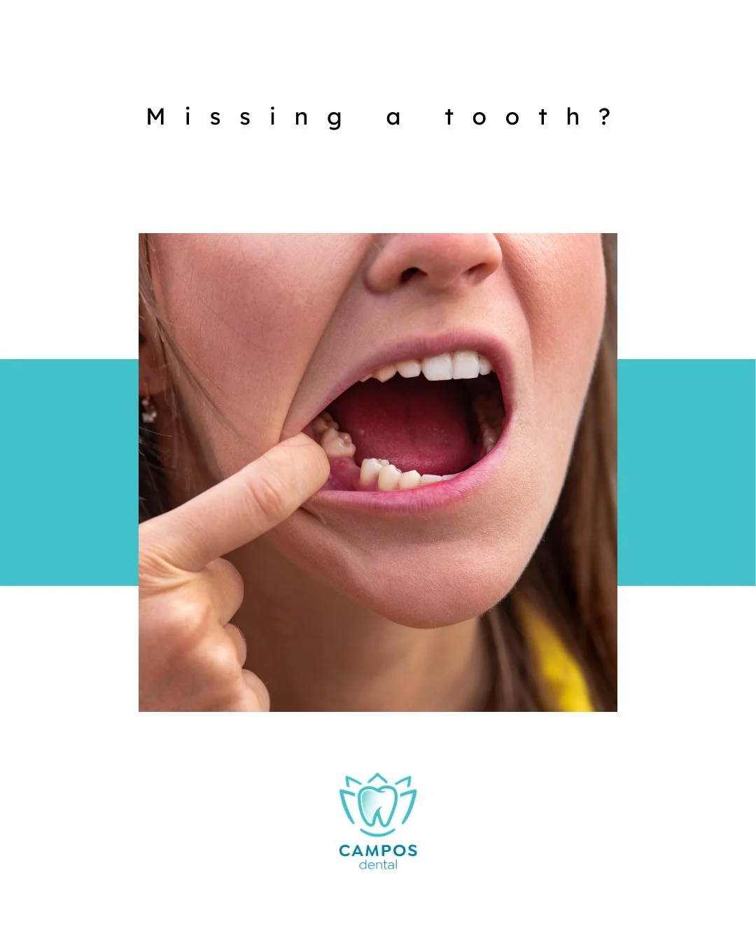 Dental implants give you a permanent, natural-looking smile that won&rsquo;t slip or slide. At Campos Dental, we make the process simple and comfortable &mdash; so you can eat, speak, and smile with confidence again. 

😁 Find out more and book your 