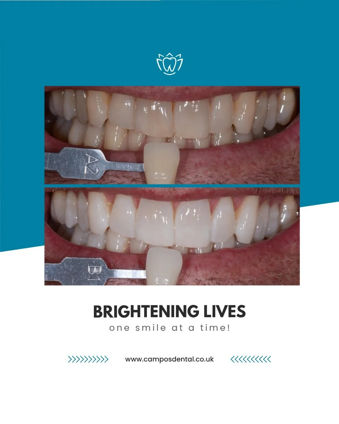 At Campos Dental, we recently helped a patient from Edgware who was experiencing noticeable yellowing of their teeth&mdash;ageing, diet and lifestyle (including smoking) had taken their toll.

After a comprehensive assessment, we fitted custom whiten
