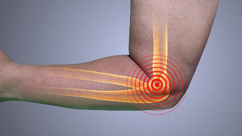 Illustration showing the elbow joint with highlighted area representing tennis elbow pain