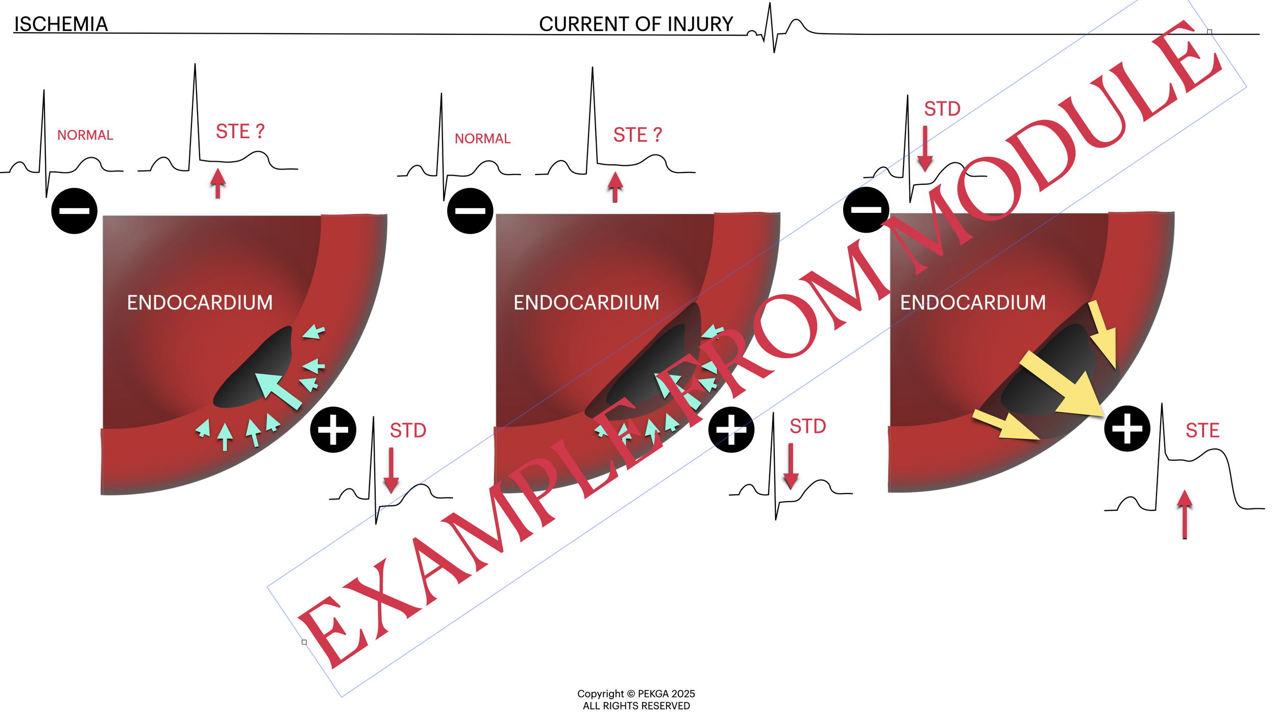 Diagram illustrating different stages of myocardial ischemia and injury, showing changes in the endocardium, with labels for normal, ST elevation, and ST depression, along with EKG tracings and arrows indicating injury patterns.