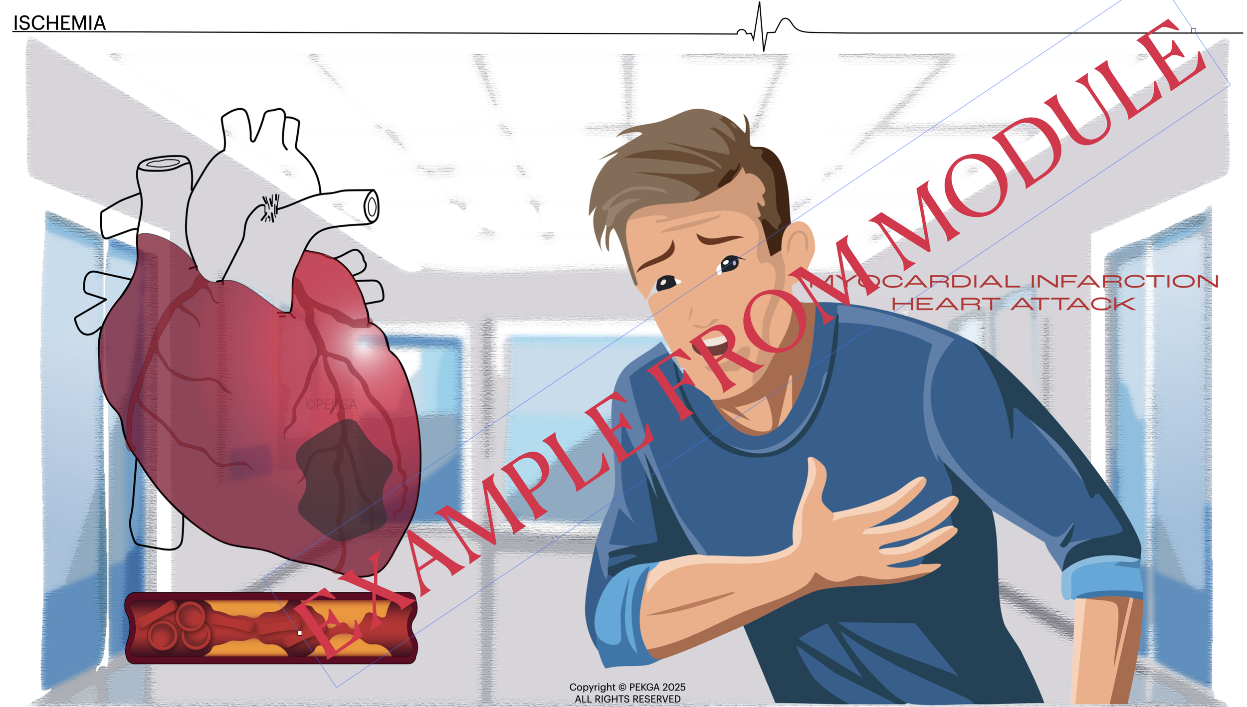 An animated illustration of a young man clutching his chest, showing signs of a heart attack, with an enlarged, highlighted heart and a blocked artery. The background depicts a medical setting, and the image includes labels related to ischemia, myoca