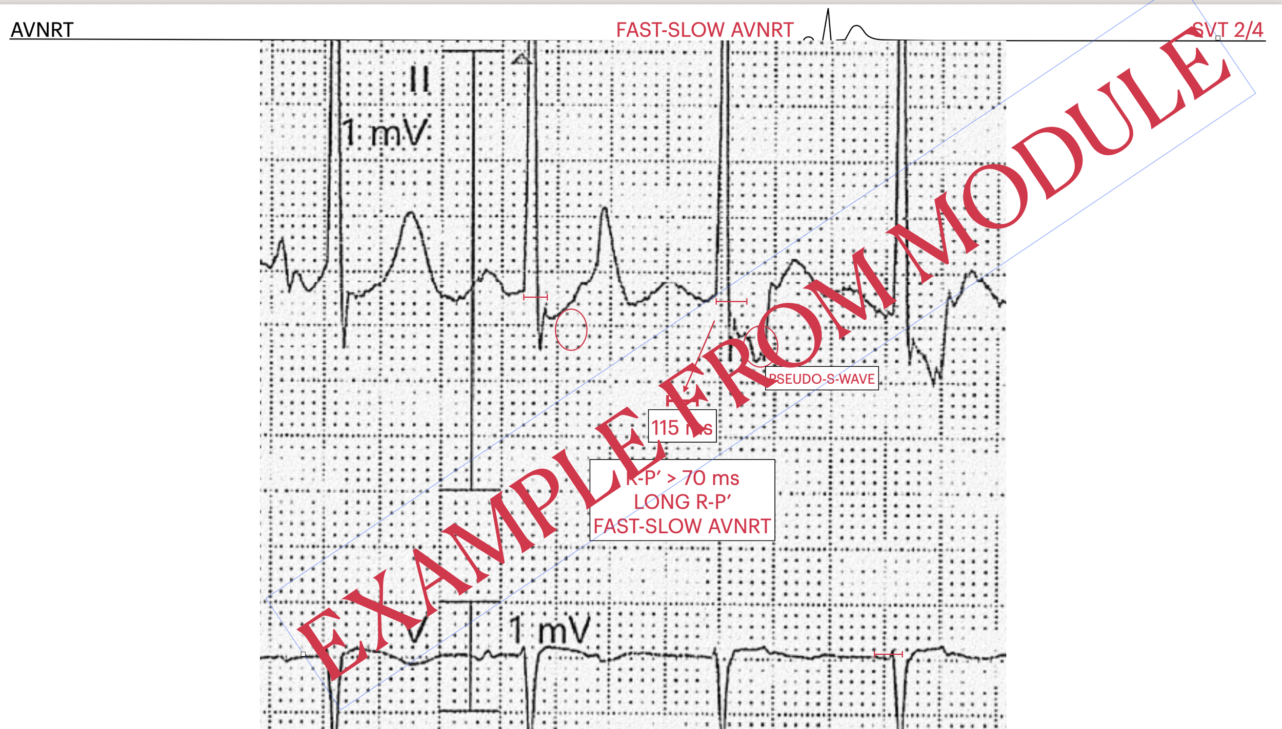 Electrocardiogram (ECG) tracing showing fast-slow atrioventricular nodal reentrant tachycardia (AVNRT). Annotations highlight features such as pseudo-s-wave, long R-P' interval greater than 70 milliseconds, and the presence of a pseudo-s-wave, with a
