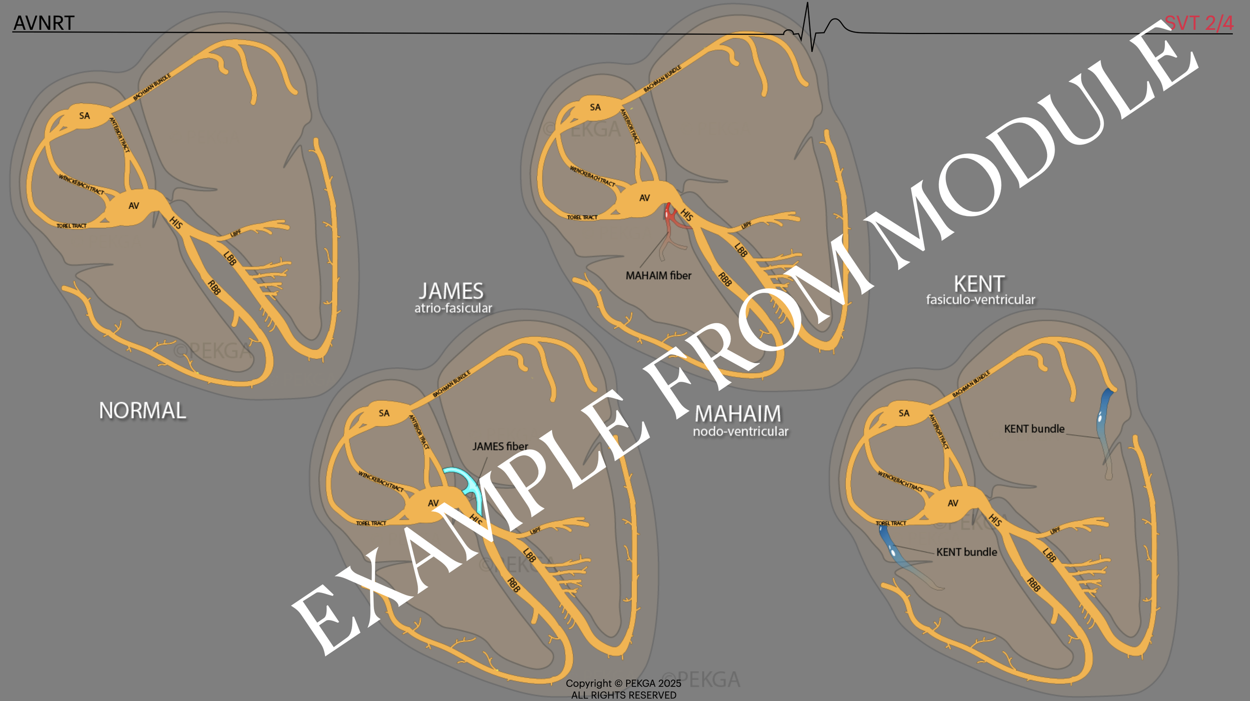 Diagram showing different types of ventricular septal defect (VSD): normal heart, atrio-fascicular, node-ventricular, and fasciculo-ventricular VSDs, with labels indicating cardiac structures and pathways.