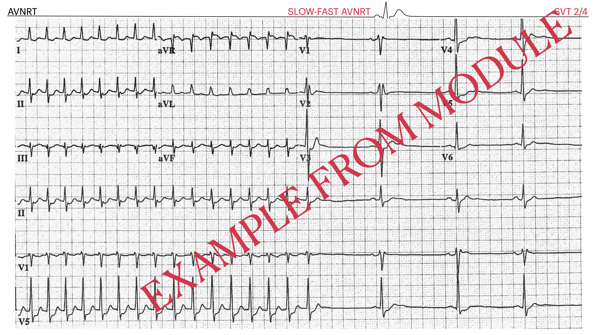 Electrocardiogram (ECG) printout showing a slow-fast atrioventricular nodal reentry tachycardia (AVNRT) with a 2:4 ventricular response.