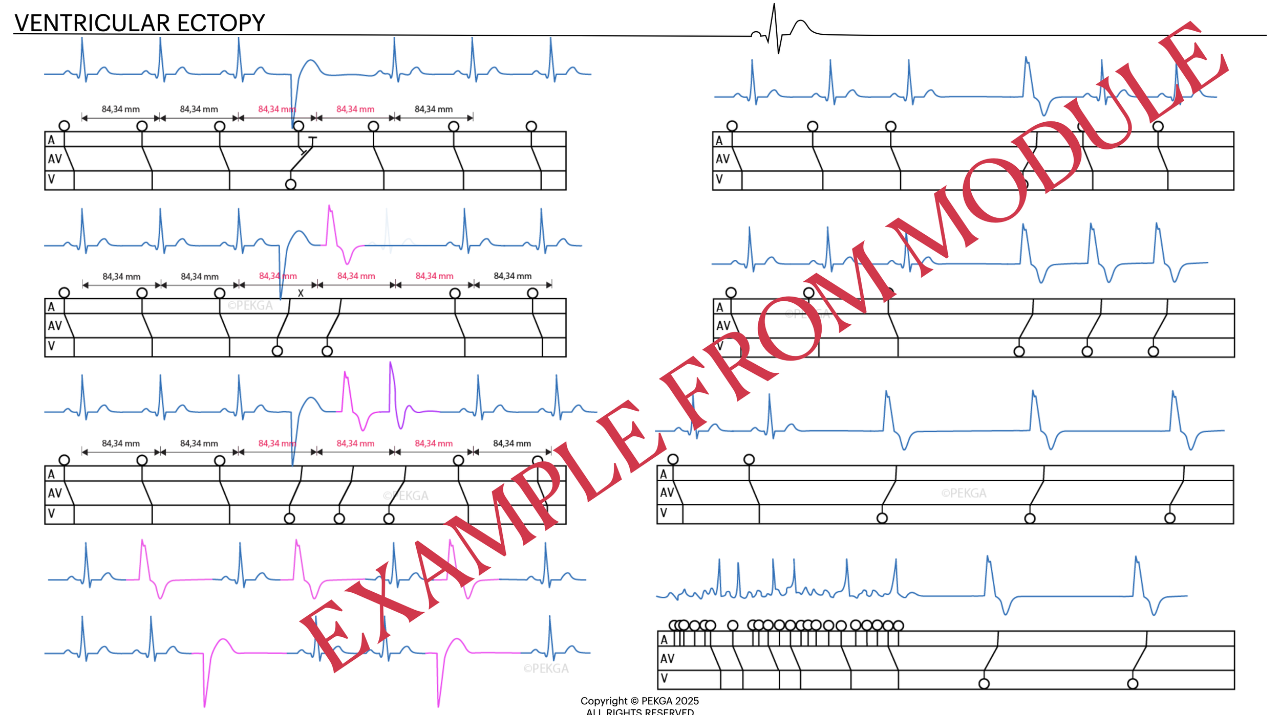 A diagram illustrating a ventricular ectopy heart rhythm with multiple electrocardiogram images, showing different types of heartbeats and their corresponding electrical activity patterns, with annotations and measurements in millimeters. The image h