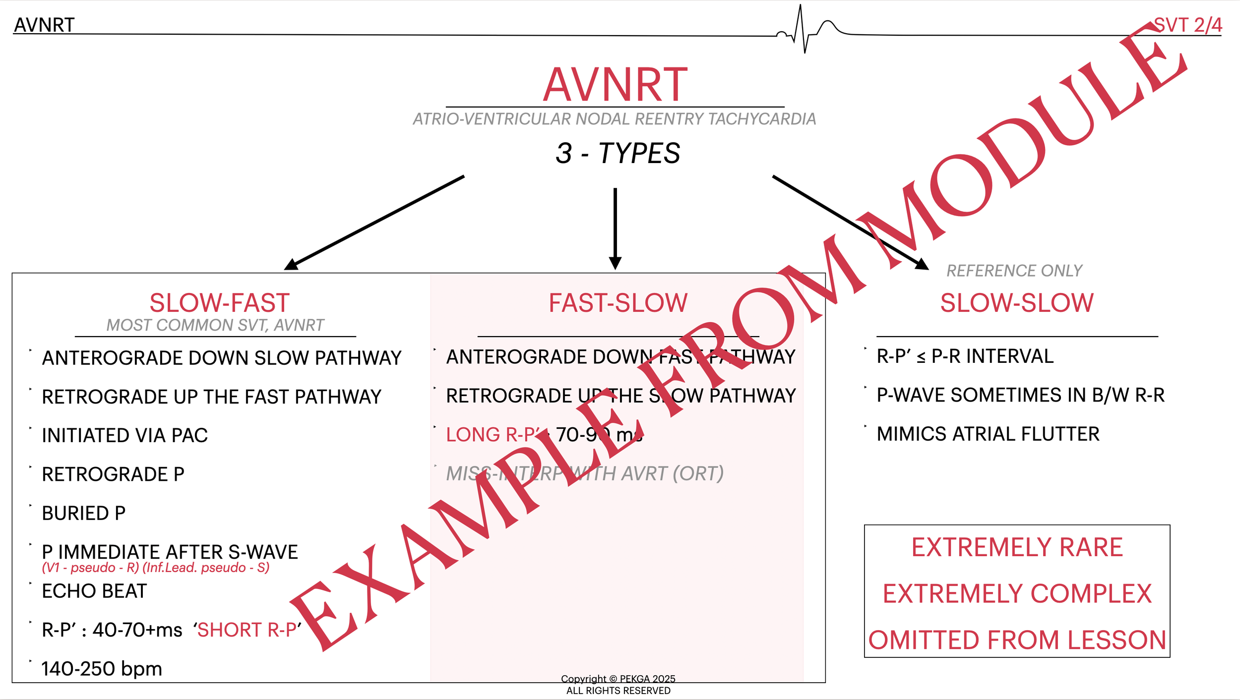 Diagram explaining three types of atrioventricular nodal reentry tachycardia, titled AVNRT. The types are slow-fast, fast-slow, and slow-slow, with details on pathways and features for each type. There is a large red watermark across the image that s