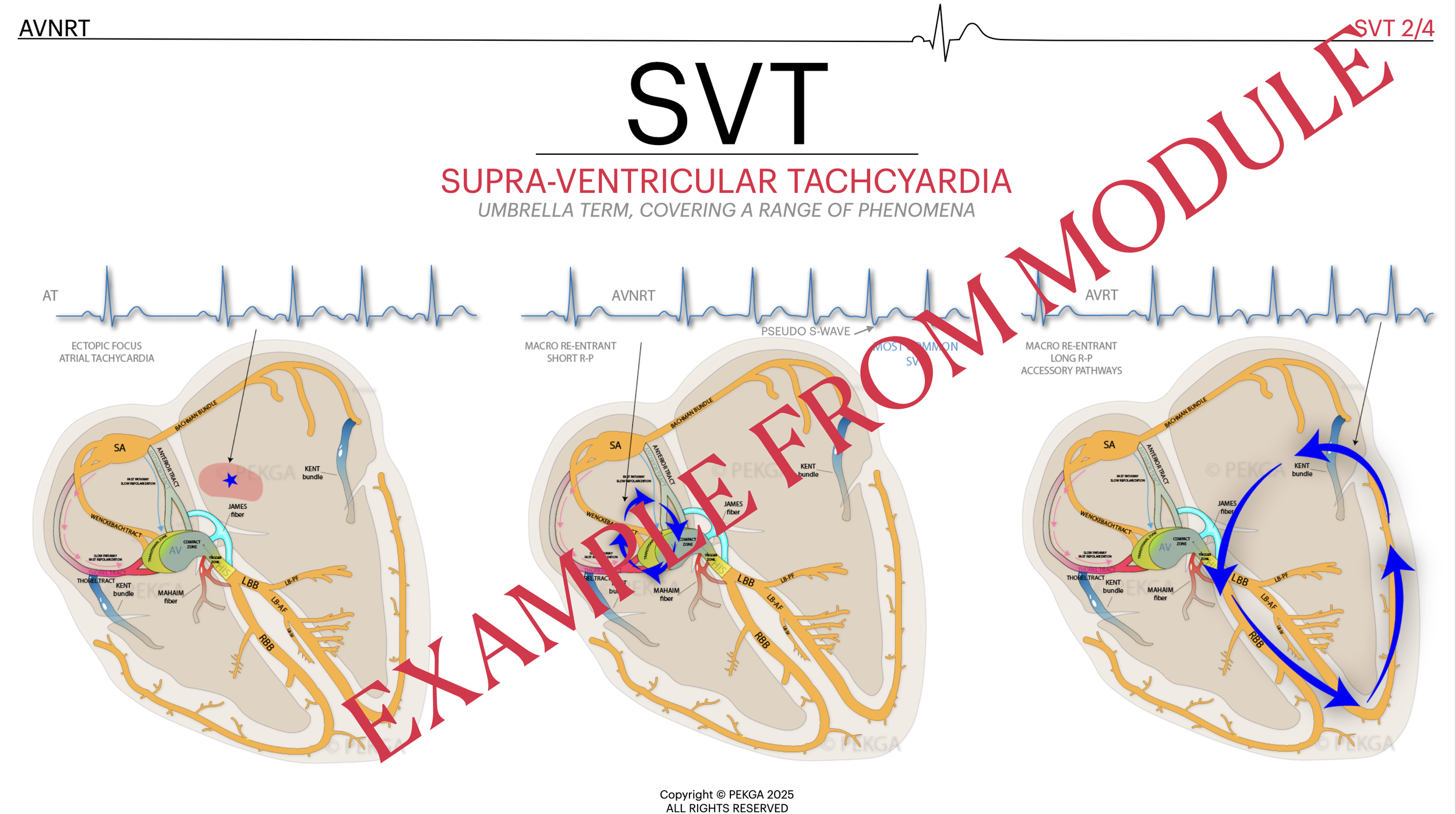 Diagram of supersystemic ventricular tachycardia showing three stages of the heart's electrical activity, with colored pathways illustrating abnormal heart rhythms and labeled structures such as the SA node, AV node, and bundle branches.