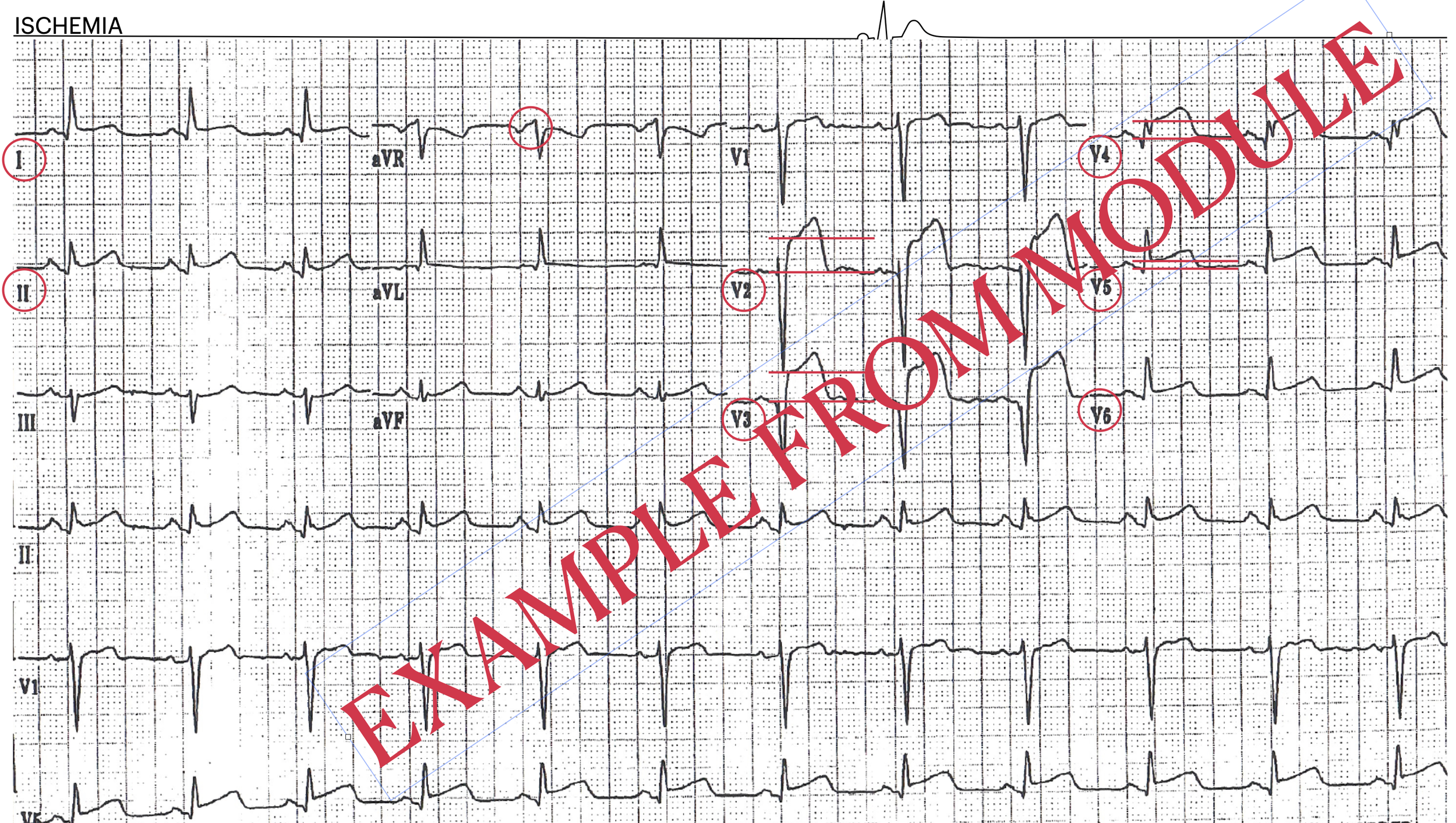 Electrocardiogram (ECG) printout showing heart rhythm with marked leads I, II, III, aVR, aVL, aVF, V1 through V6, and large red overlay text reading 'EXAMPLE FROM MOODULE'.