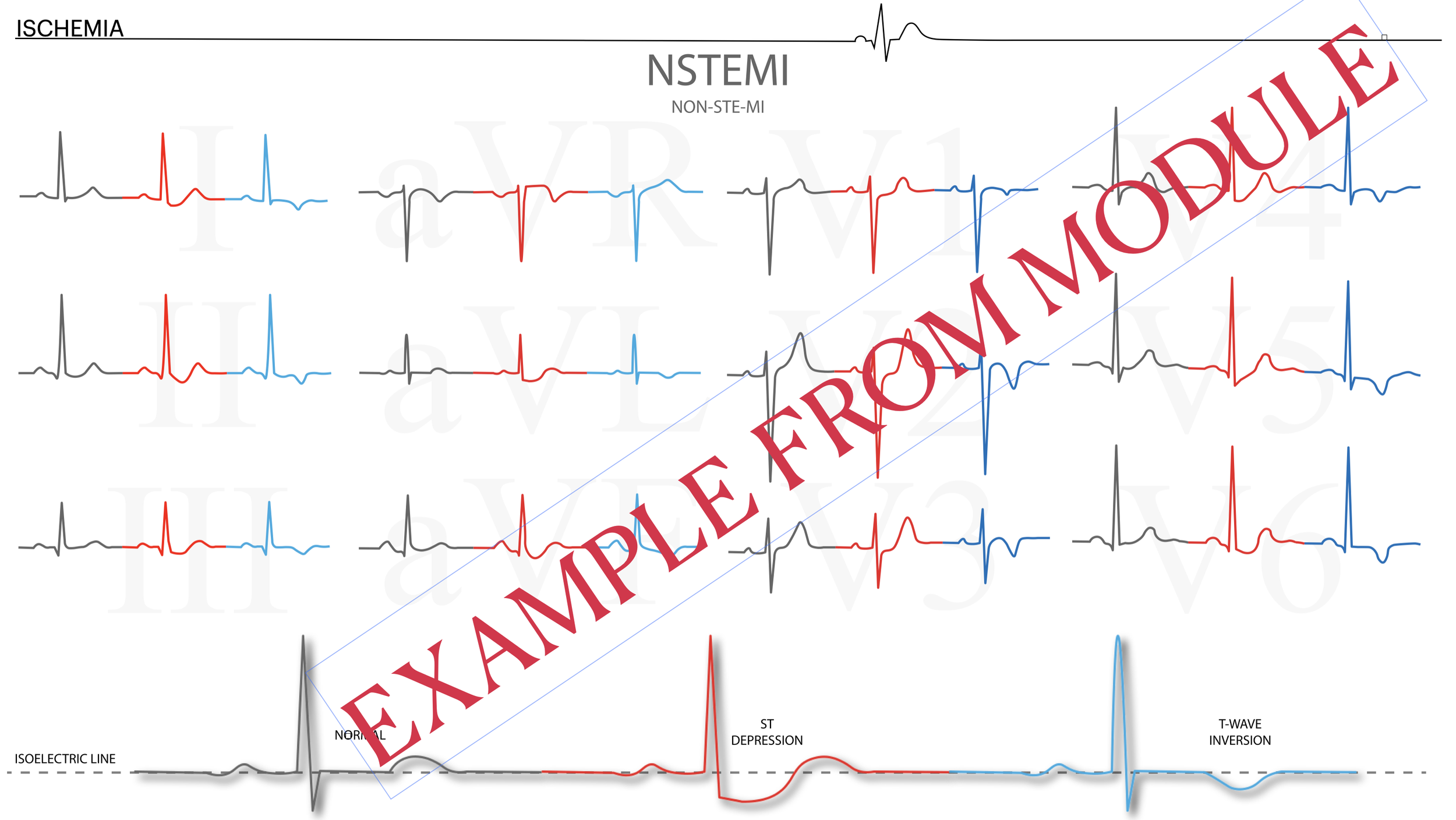 Electrocardiogram (ECG) showing patterns associated with ischemia and non-ST elevation myocardial infarction (NSTEMI). The image contains multiple ECG strips in black, red, and blue, with labels indicating isoelectric line, normal, ST depression, and