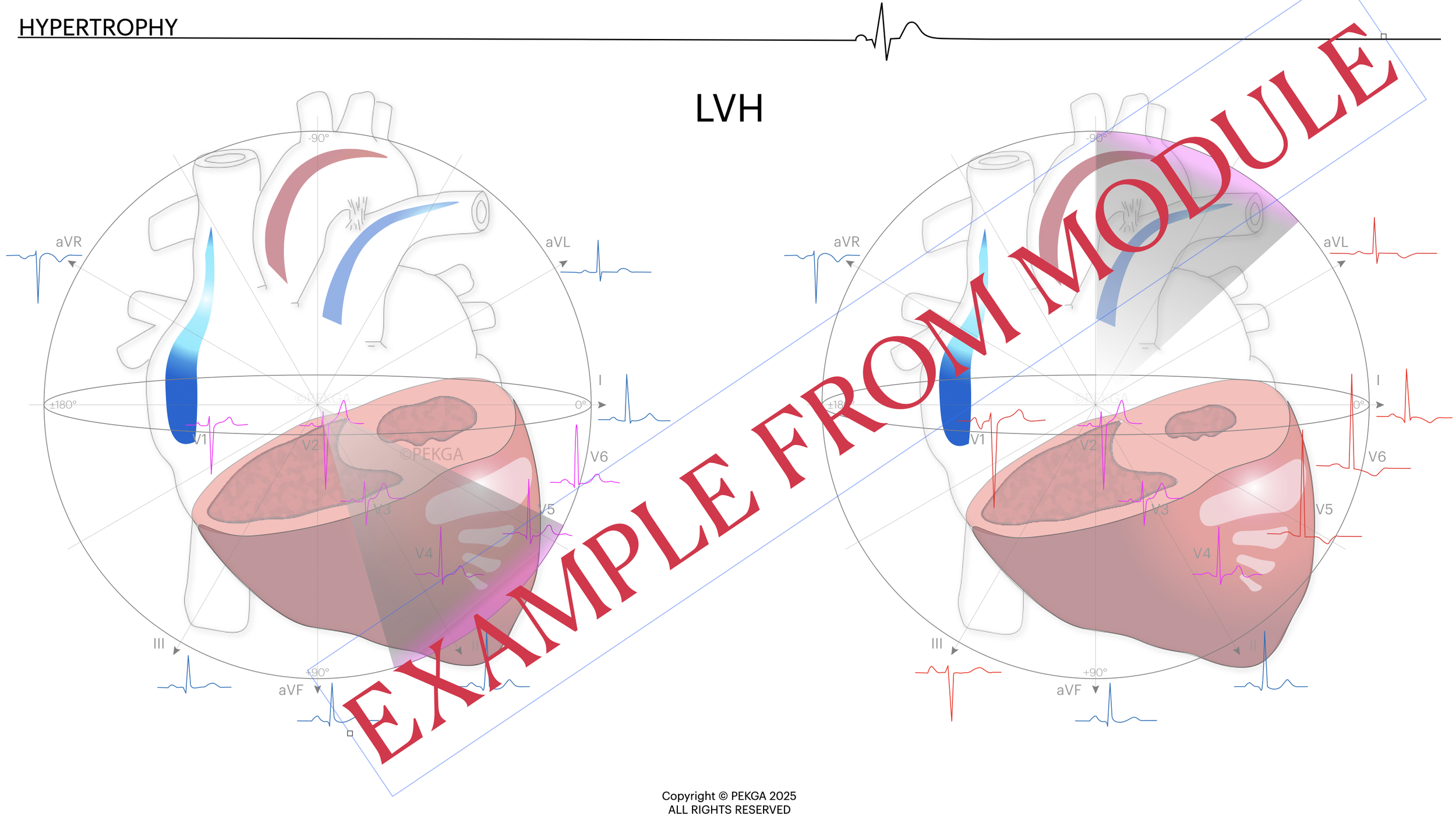 Illustration of an electrocardiogram and a heart diagram labeled 'LVH' for left ventricular hypertrophy, with a banner across the image reading 'EXAMPLE FROM MODULE' in red text.
