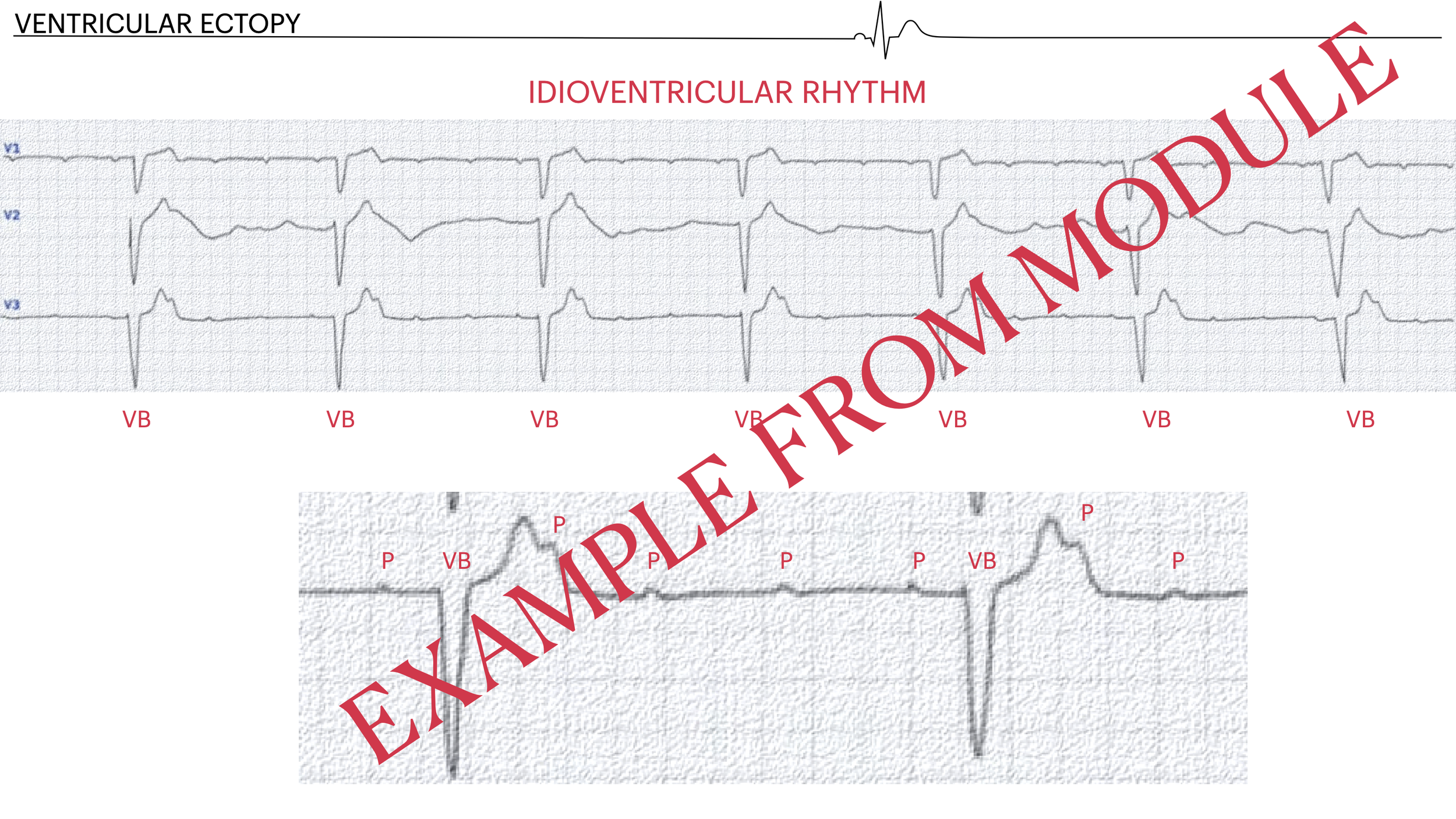 Electrocardiogram (EKG) showing ventricular ectopy with repeated VBs and a discordant P wave in the lower rhythm strip, indicating idioventricular rhythm, labeled in red and overlaid with the text 'EXAMPLE FOR MODULÉ' in red.