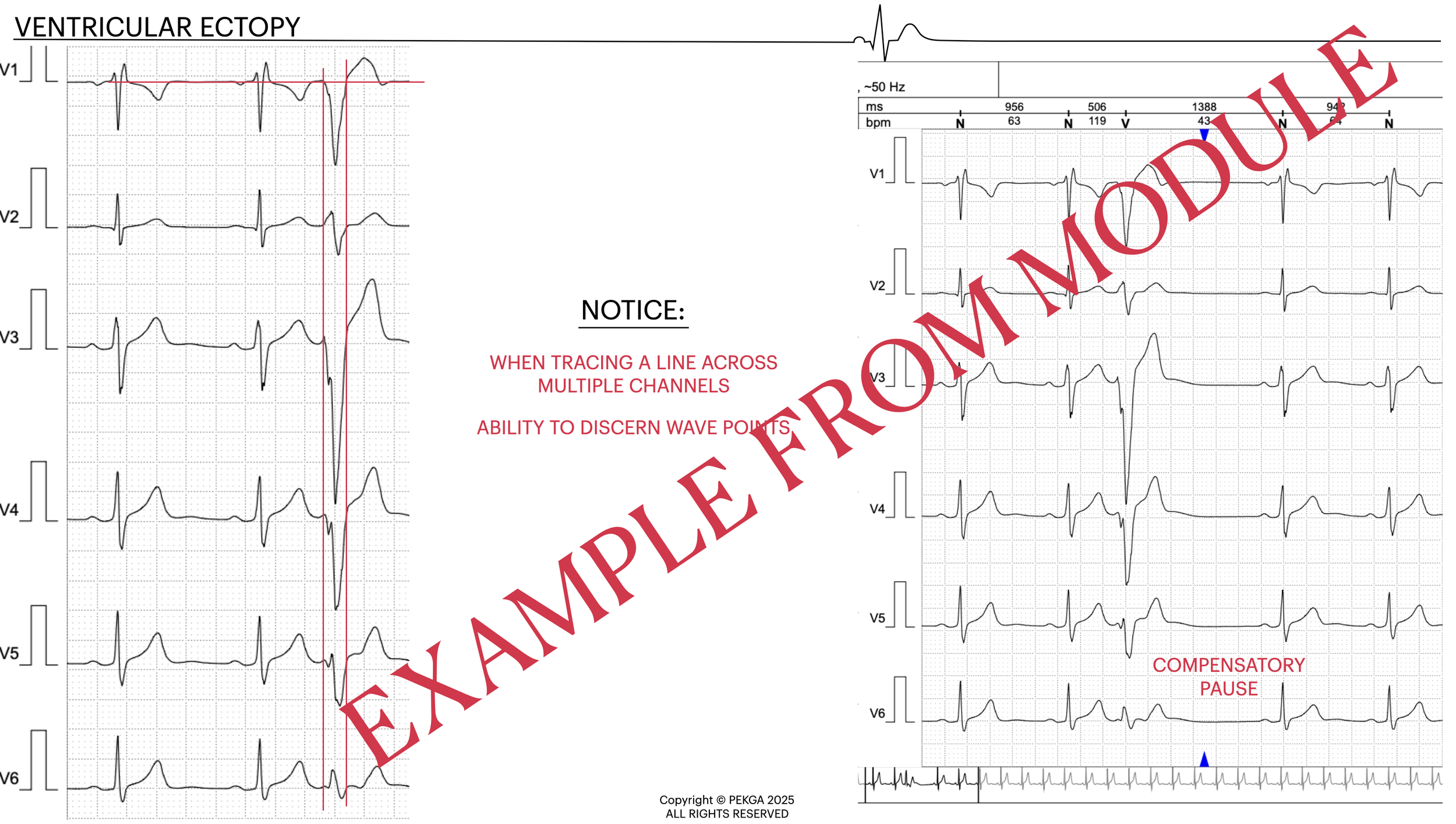 Electrocardiogram (ECG) printouts showing ventricular ectopy with a large red diagonal watermark reading 'EXAMPLE FOR DEMONSTRATION'. Text on the image indicates it is a sample ECG for educational purposes, with notes about tracing lines across chann