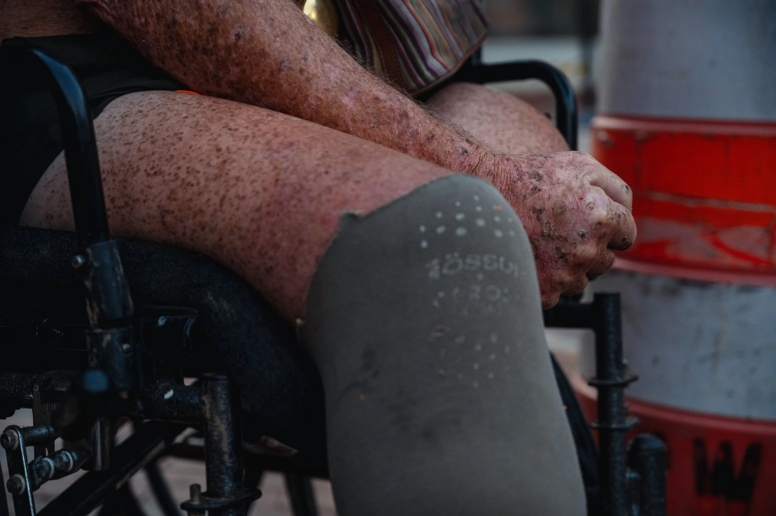 Buck, a double-leg amputee, worries about his health after a doctor recently told him his remaining leg would soon need to be removed.
