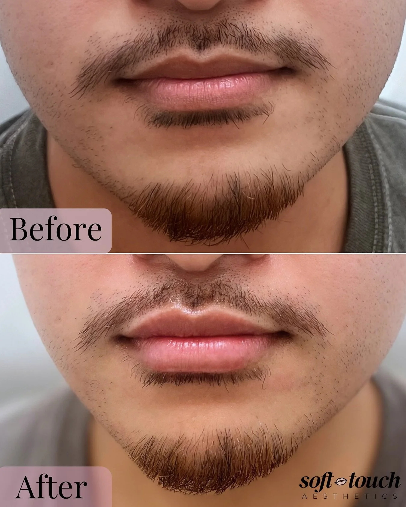 When it&rsquo;s done right, no one knows, they just see fresh lips. For this client, the goal wasn&rsquo;t fullness, but hydration and natural definition, keeping everything seamless while maintaining a strong, masculine look.

If you&rsquo;re curiou
