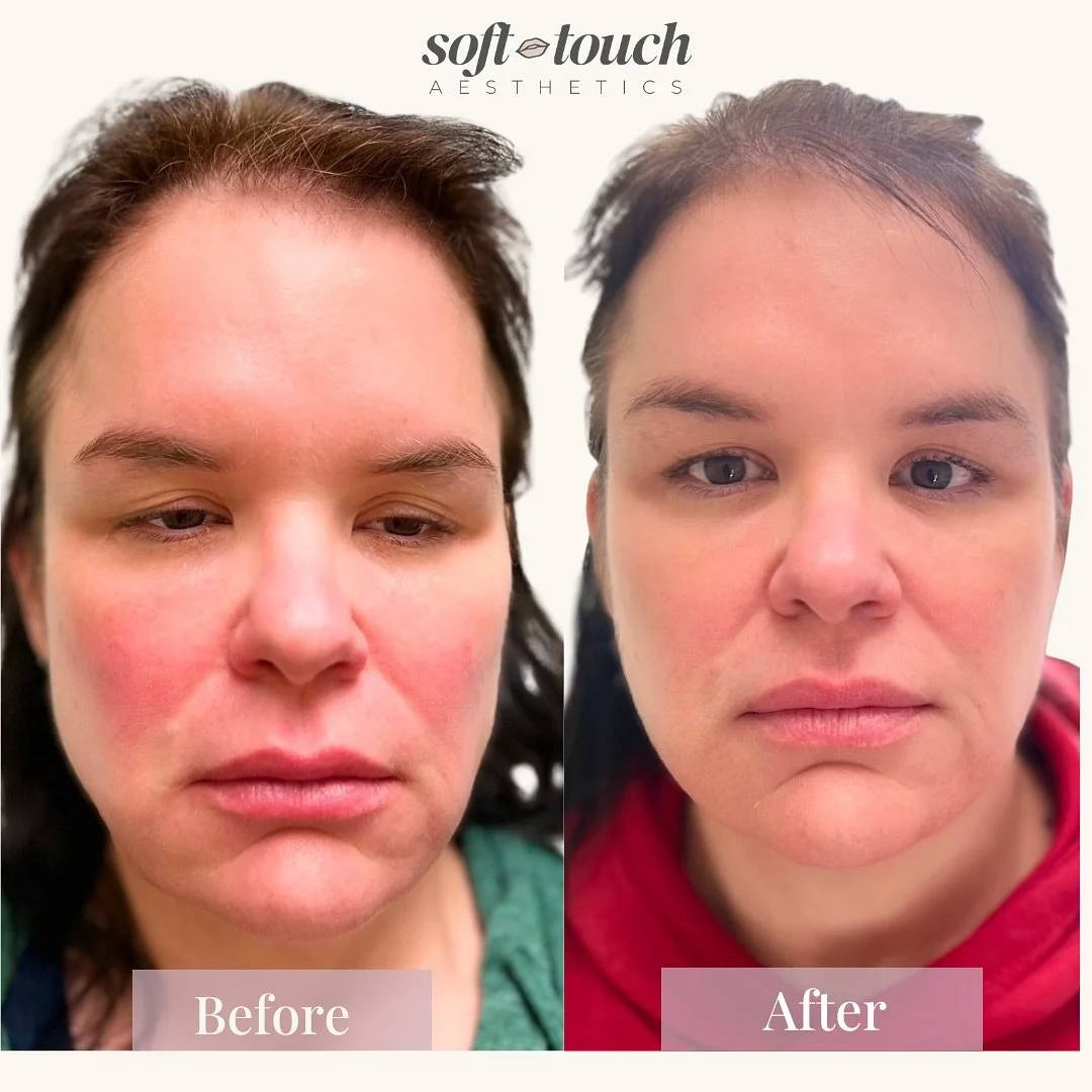 ✨ Full Facial Balancing Transformation 

This is a powerful example of what can happen when we approach the whole face instead of focusing on one area alone. My client&rsquo;s biggest concern was that she looked tired and stressed, even when she felt