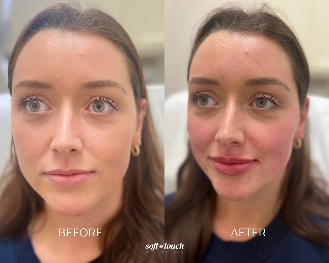 Fresh Lips 👄💉✨

If you&rsquo;re looking for natural looking results, Soft Touch Aesthetics is for you. 

We specialize in making sure all treatments keep your face balanced, while enhancing refinement, shape, size, and hydration! ✨

Book a consulta