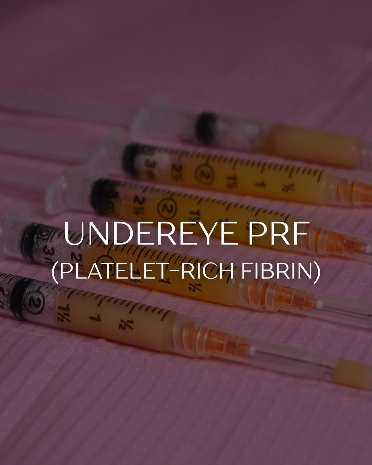 ✨ Restore. Rejuvenate. Radiate. ✨

Under-eye PRF (Platelet-Rich Fibrin) is a natural regenerative treatment that uses your body&rsquo;s own growth factors to stimulate collagen production and improve skin quality over time.

Through precise placement