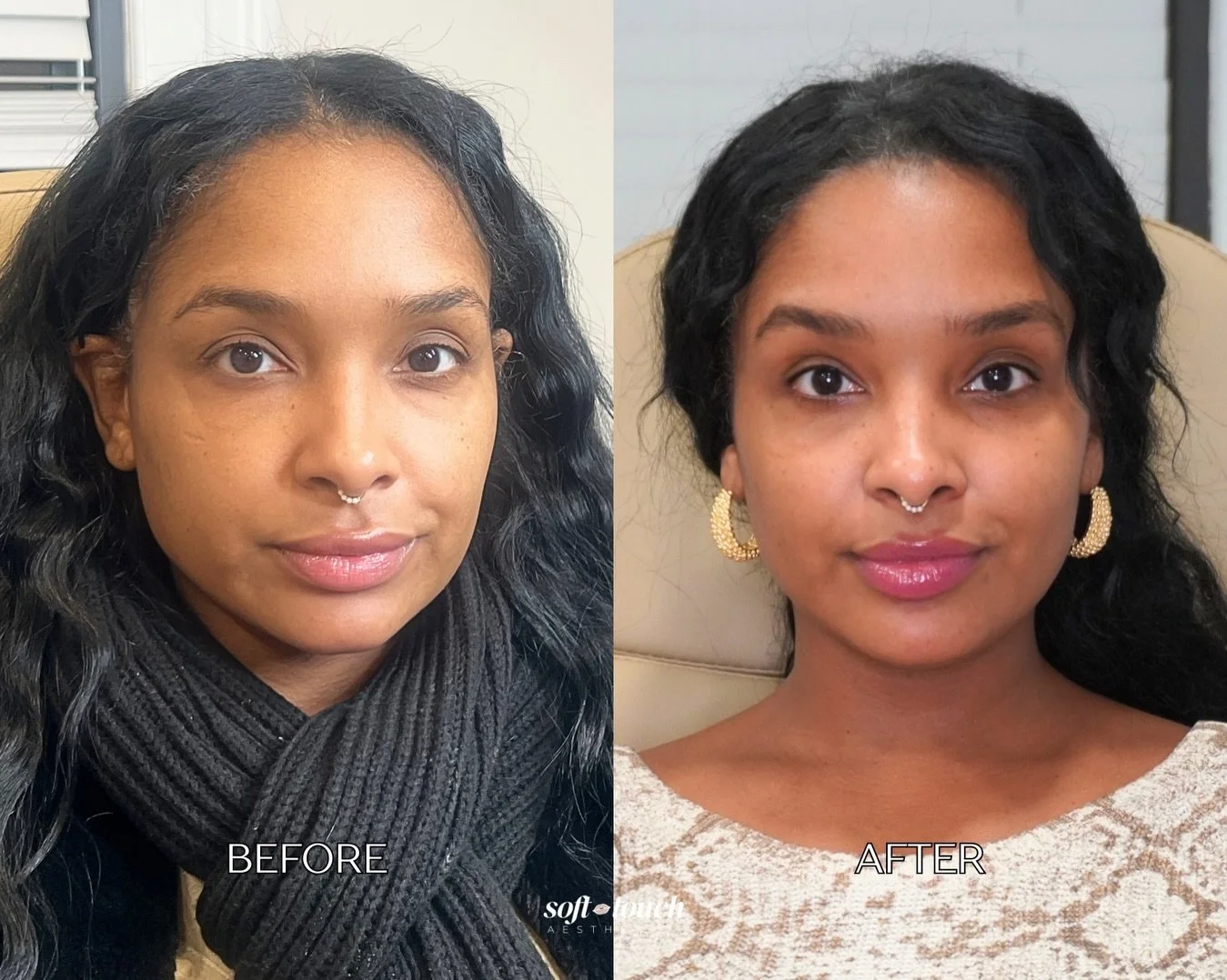 She originally came in wanting lip refinement&hellip;

After a full facial assessment, we decided not to add additional volume to her lips. She previously had them treated elsewhere and was already at a beautiful fullness.

Instead, we focused on res