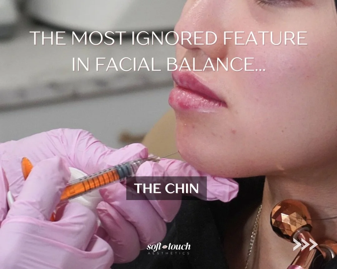 Everyone talks about lips. Very few talk about the chin.

The chin anchors the lower third of the face. If the mentalis muscle is overactive, it can create tension, dimpling, or downward pull that throws off proportions.

Chin Botox addresses muscle 