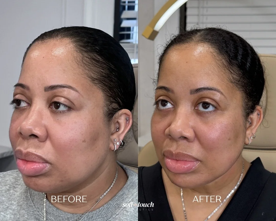 She came in feeling like her face had gotten
rounder over time, without knowing why. 🤔

We focused on restoring structure through jawline + chin definition, mid-face support for lift, and masseter Botox to slim the face.

All done gradually over mul