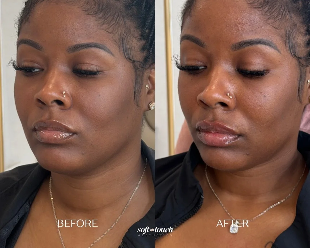 This client came in wanting a little more definition and volume, but still wanted her lips to look very natural.

We approached this slowly to build shape and structure while preserving her natural lip shape 👄