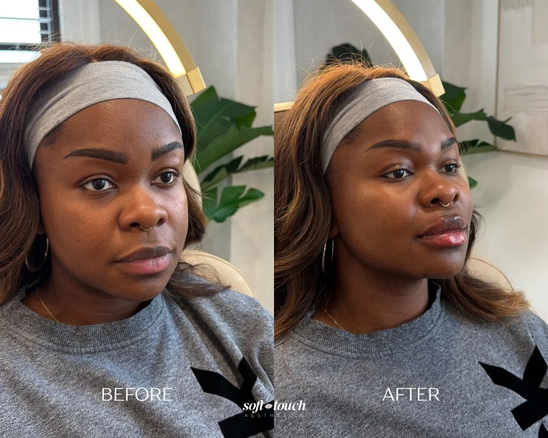 This beauty came in for a full facial balance. One of our main goals was to reduce some roundness and bring more definition to her jaw line. 

For her, we added some additional volume and hydration to her lips, restored structure through jawline &amp