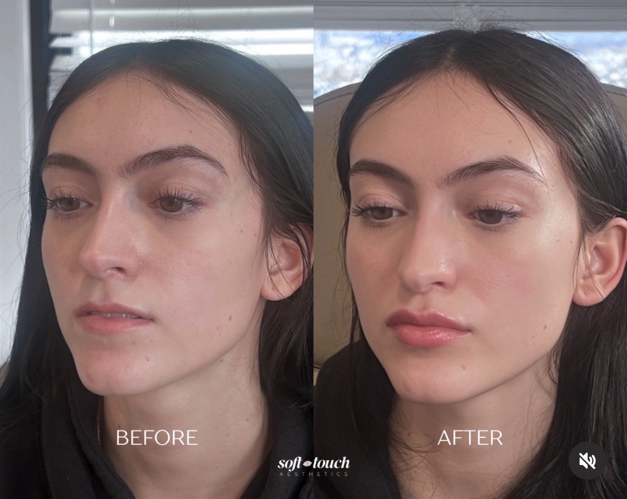 Side-by-side before and after images of a patient following a lip filler treatment, showing enhanced lip volume, definition, and natural facial balance.