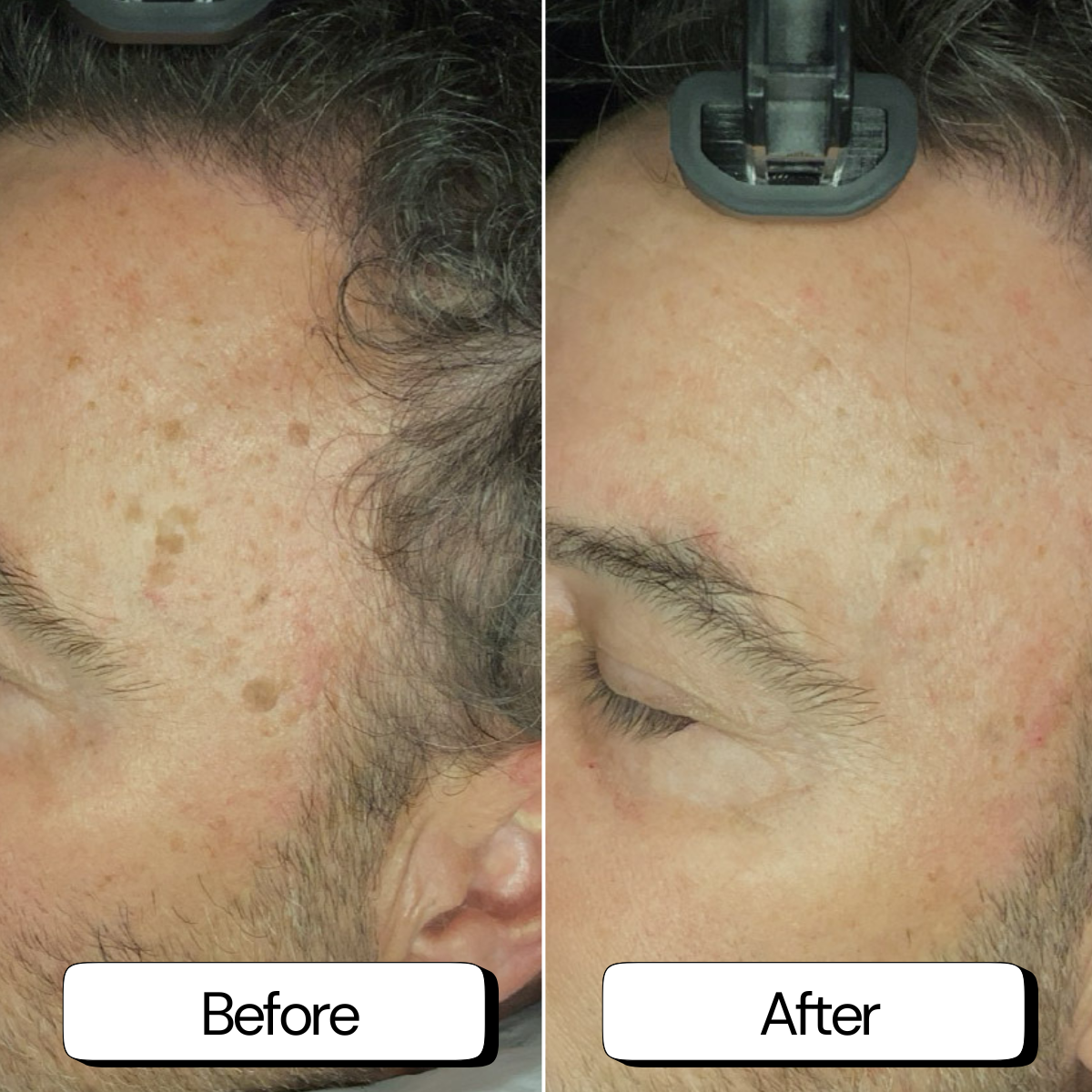 Sun spots + freckles removal at Skin Xclusive, the best Skin Care Clinic in Melbourne