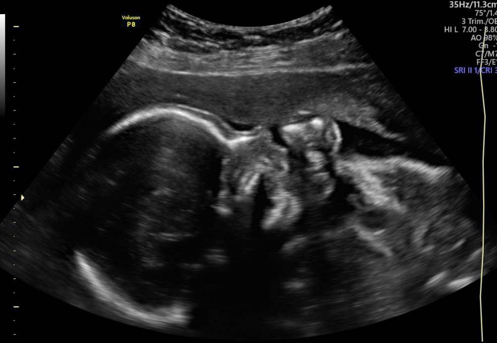Medical ultrasound image showing fetal heart ultrasound with fetal heart rate (FHR) at 147 beats per minute and Doppler waveforms.