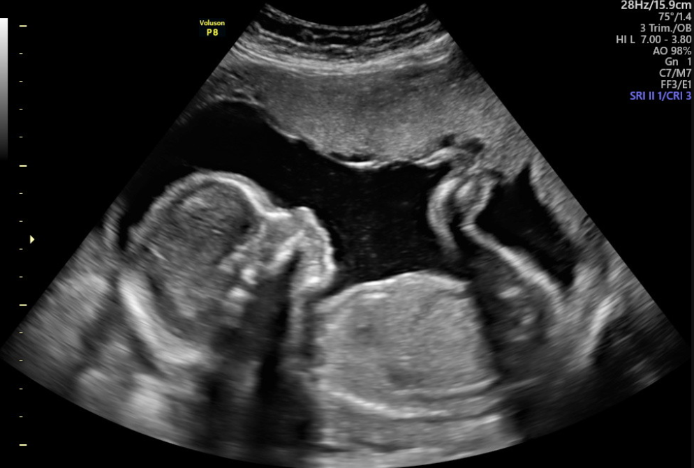 Ultrasound image of a developing fetus in the womb