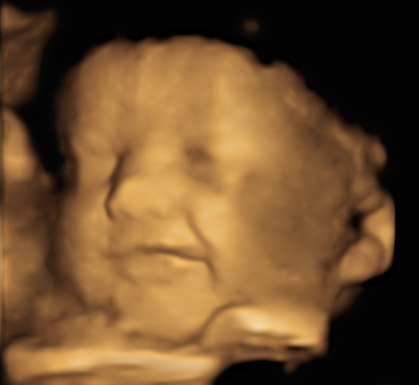 3D ultrasound image of a baby