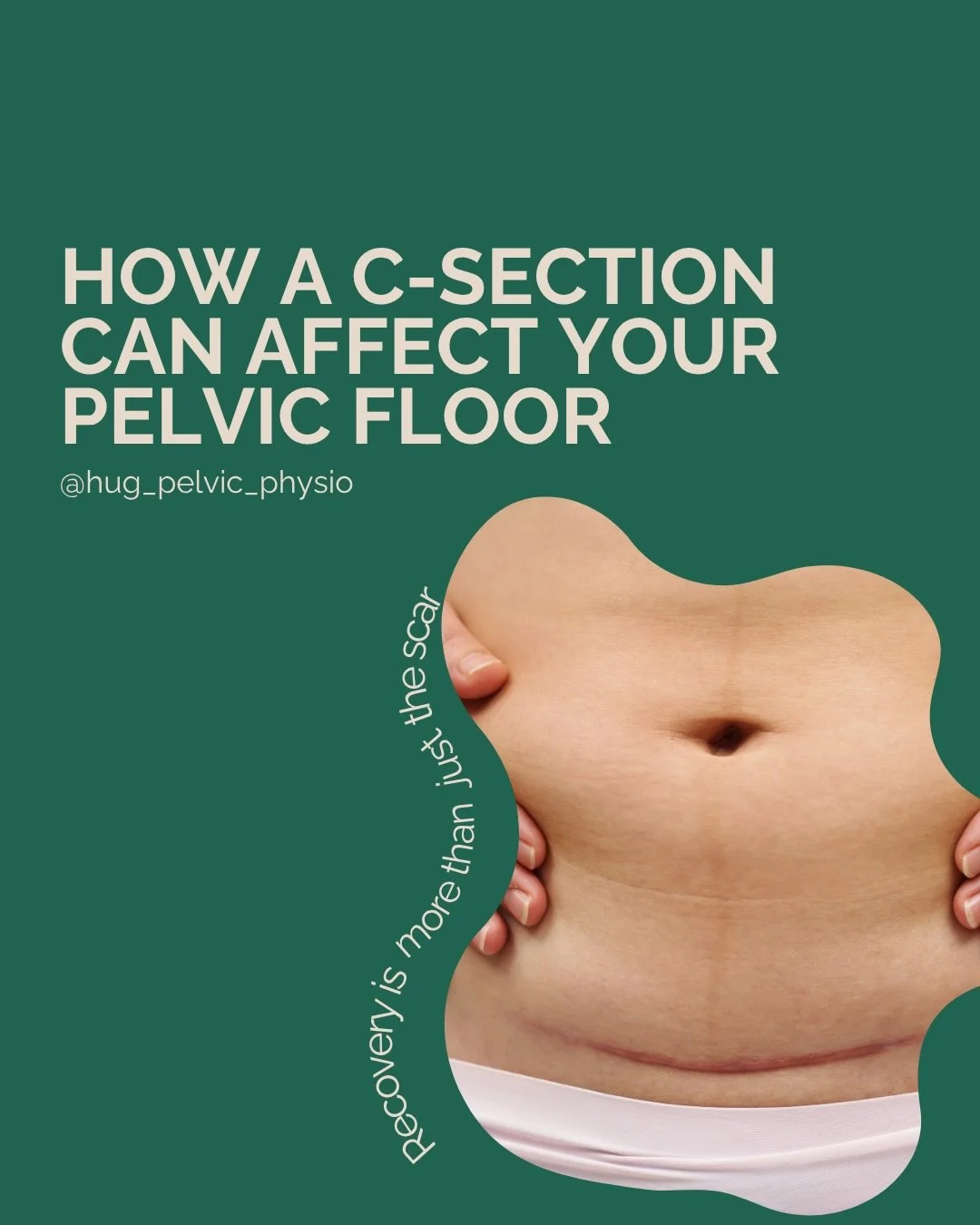 C-section doesn&rsquo;t mean your pelvic floor is unaffected

Pregnancy, surgery and recovery all influence how your core and pelvic floor function together. 

You might notice changes in strength, coordination or pressure dispersion.

That&rsquo;s w