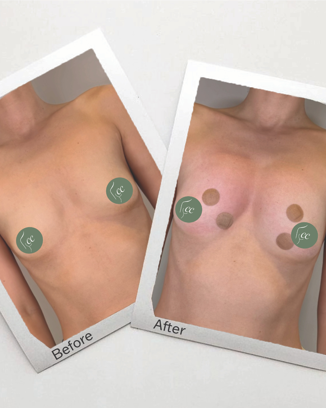 Non-surgical breast enhancement.png