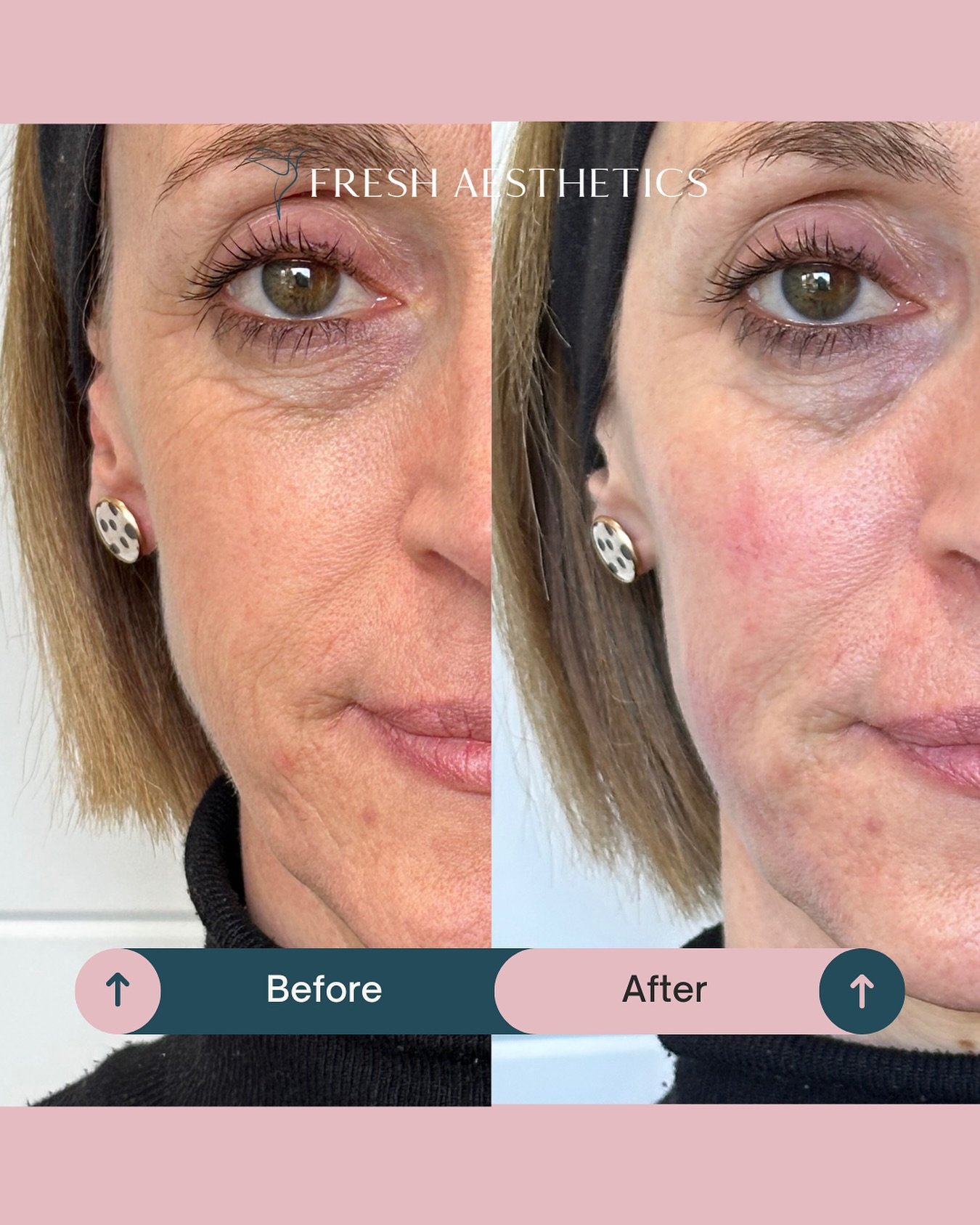 🎯What are we aiming for with aesthetic treatments? 

🙅&zwj;♀️We are NOT aiming for anything obvious, or jarring, massive transformations that make you look radically different 

🤫Instead we are about blurring out lines &amp; wrinkles, lessening sh