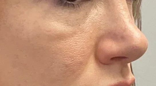 Puffy Eyes After Botox? What Causes It and How to Fix It