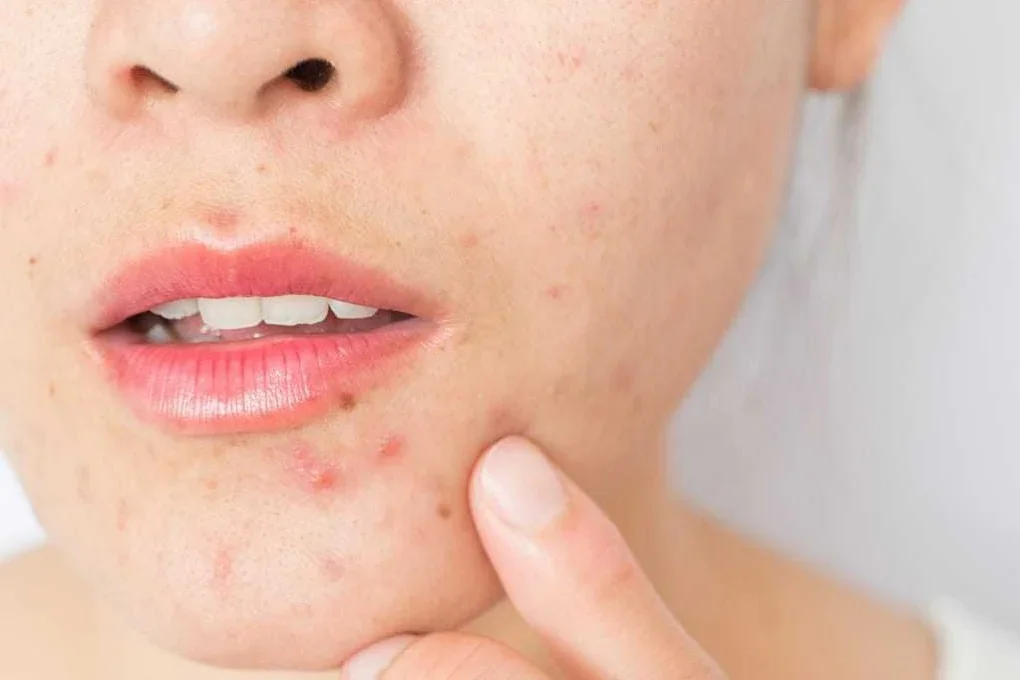 Is Your Skin Purging or Reacting? How to Tell the Difference and What to Do