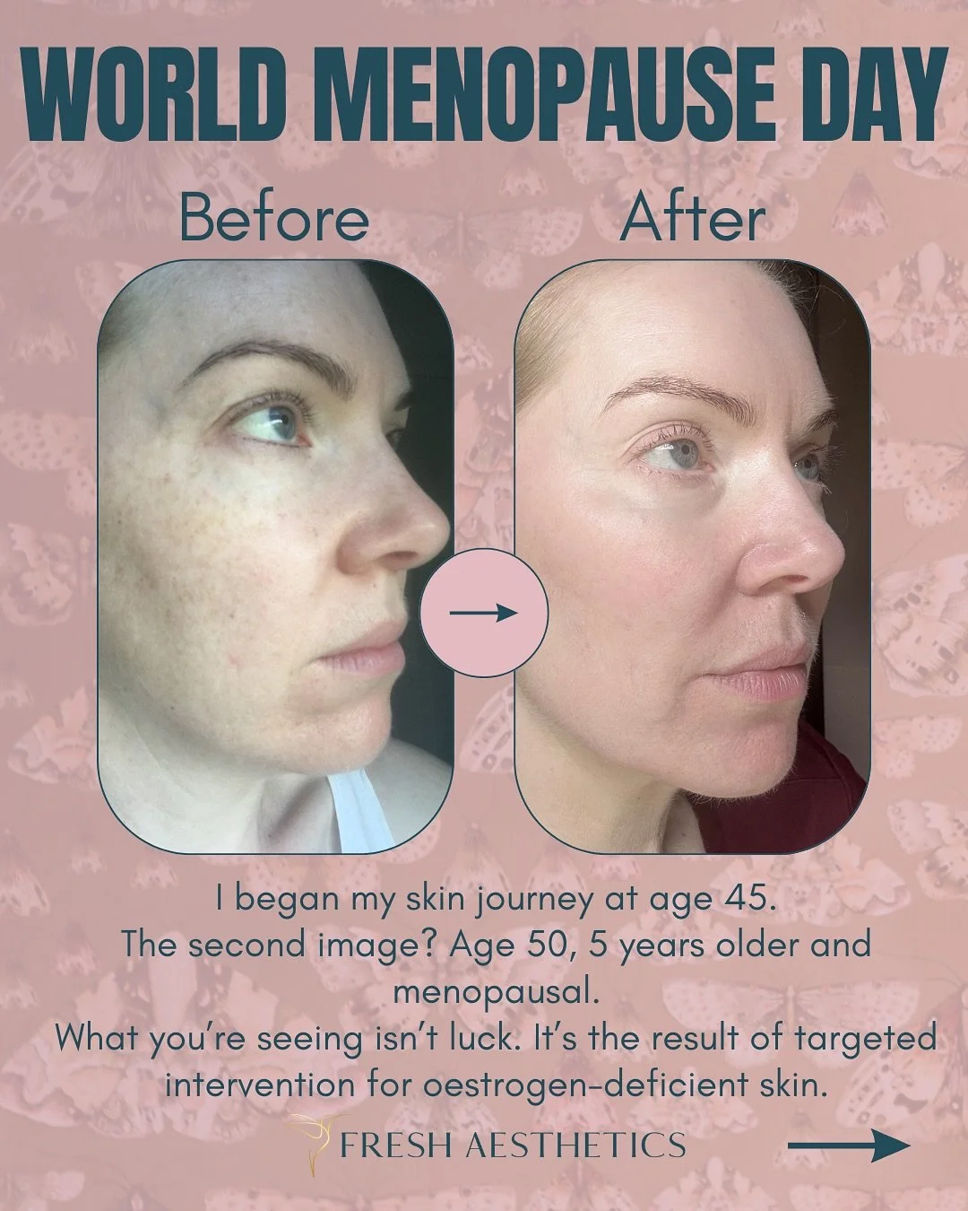 📉Oestrogen decline during perimenopause &amp; menopause affects our entire body. Our skin is no exception. 

📉The skin is rich in oestrogen receptors. These receptors help regulate vital functions such as collagen production, hydration, and barrier