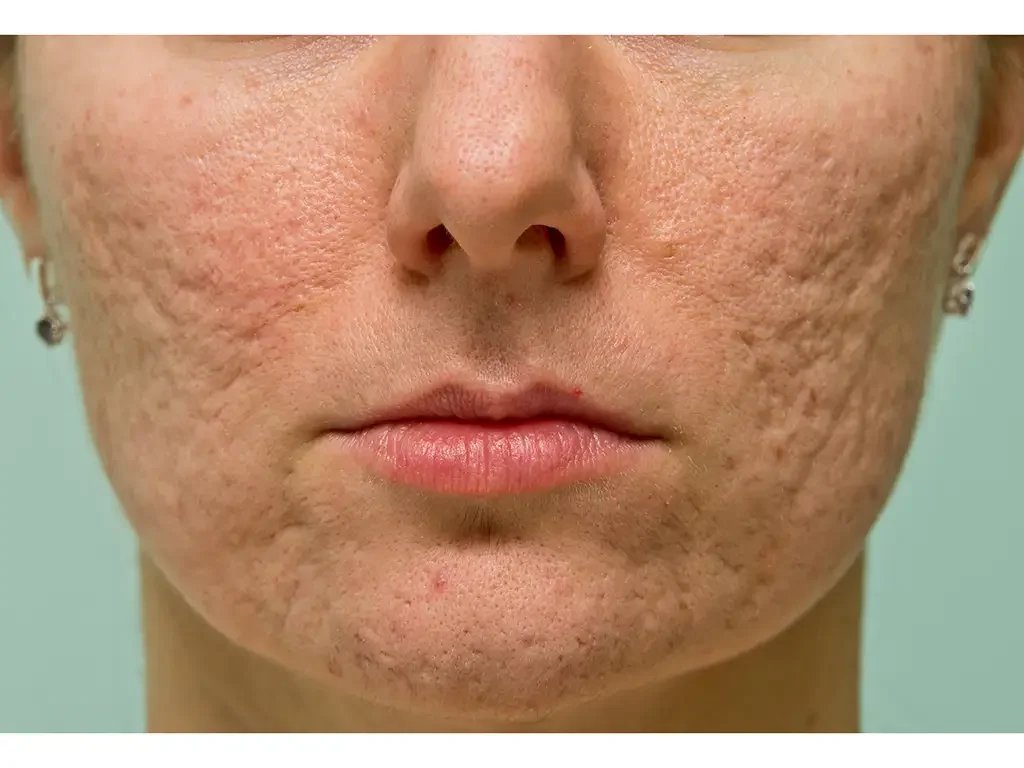 How to Treat Acne Scars: Subcision with Skin Boosters