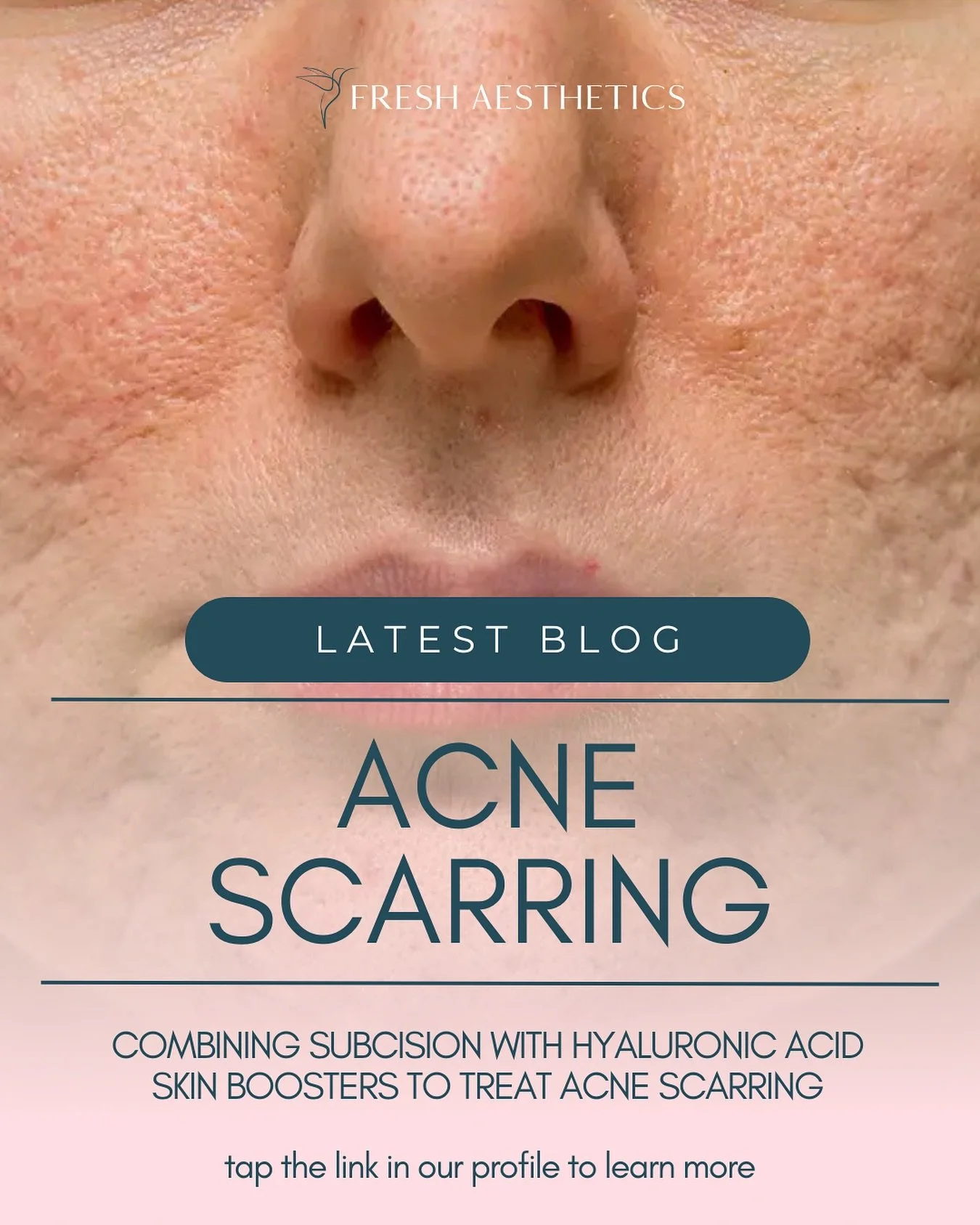 Acne scars can be an unpleasant reminder of skin problems from many years ago. They don&rsquo;t just affect the texture of your skin, they can negatively impact your confidence.

Our regenerative approach, combining subcision with hyaluronic acid ski