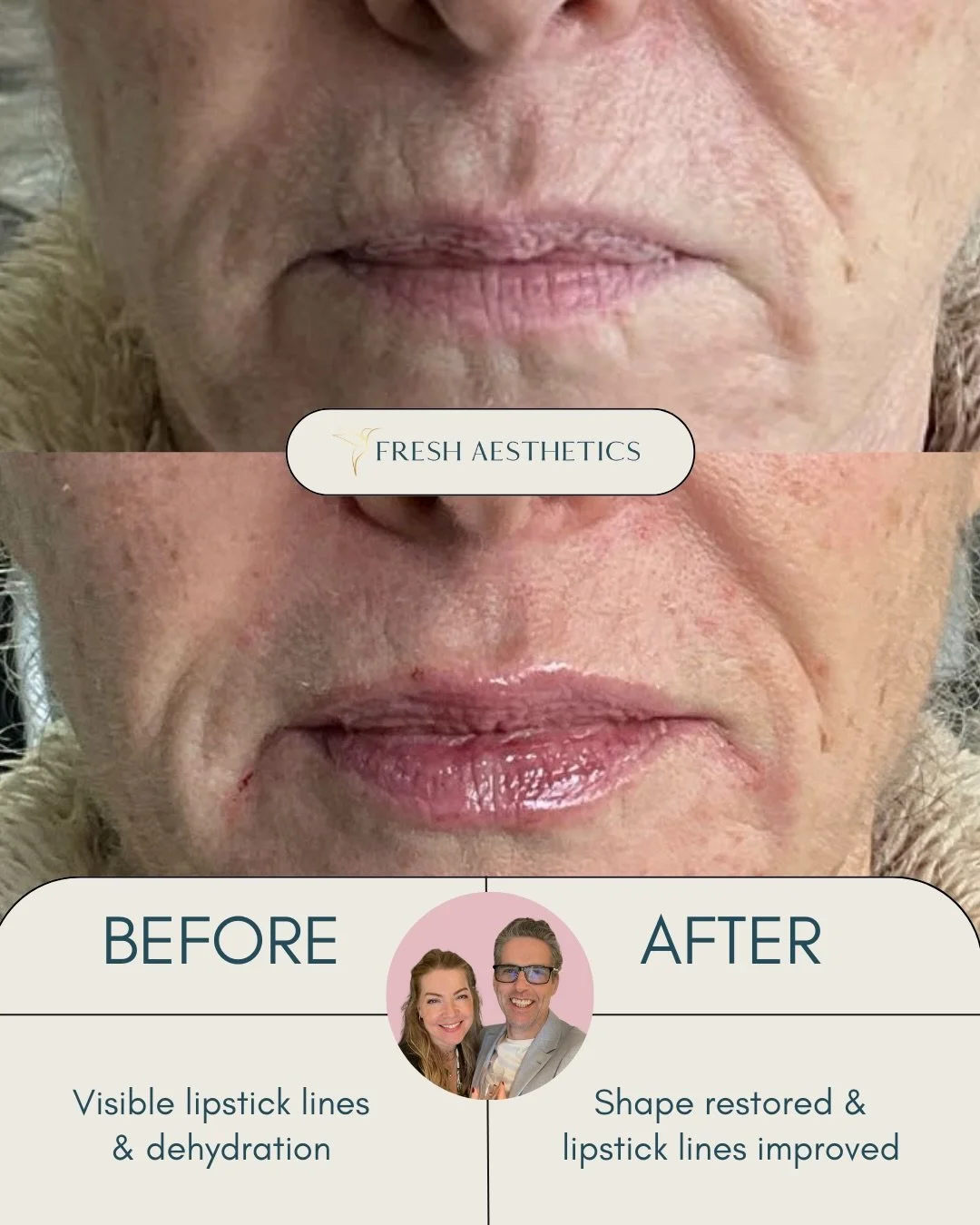 😱are you afraid of lip filler? don&rsquo;t be. It&rsquo;s because you&rsquo;ve only seen the bad ones. When the right filler is used judiciously to bring back the original shape &amp; structure of your lips it looks 😘🤌