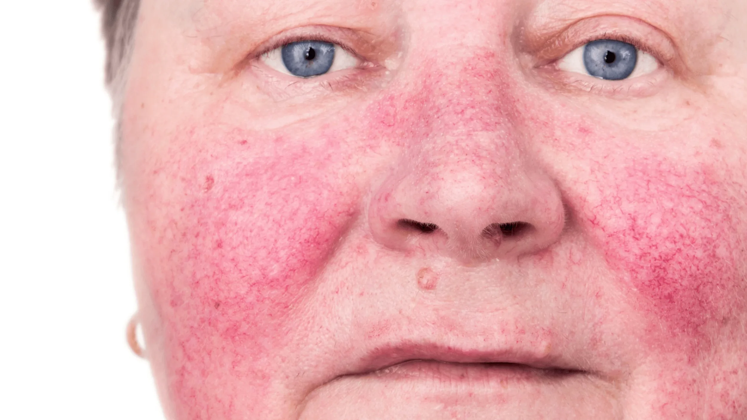 Rosacea Causes, Gut Health Connection &amp; Effective Treatments