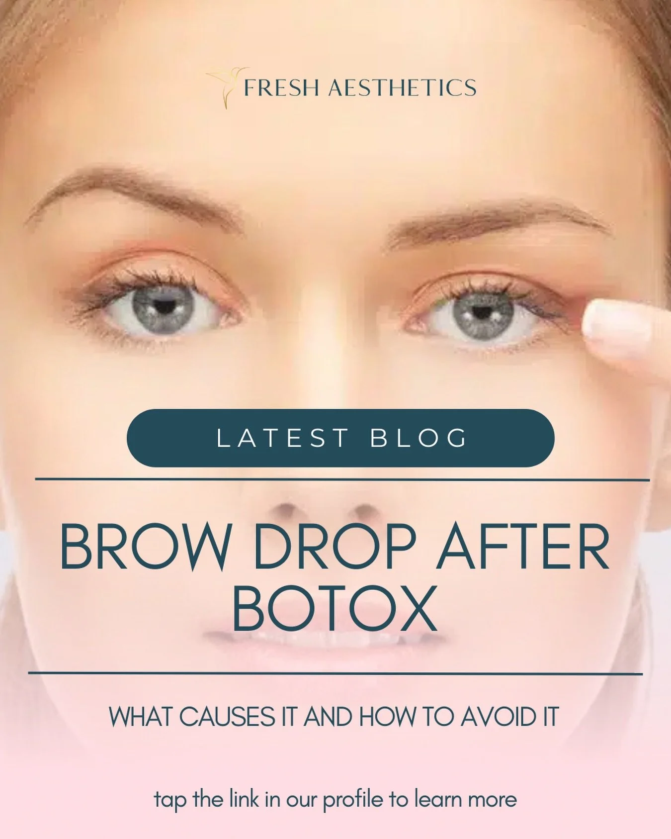 😠Brow drop, especially medial brow ptosis (where the head of the brow drops more than the tail) is a dead giveaway that you&rsquo;ve had Botox 

⚖️Your brow position is due to a fine balance between the lifting muscles (the forehead), and the muscle