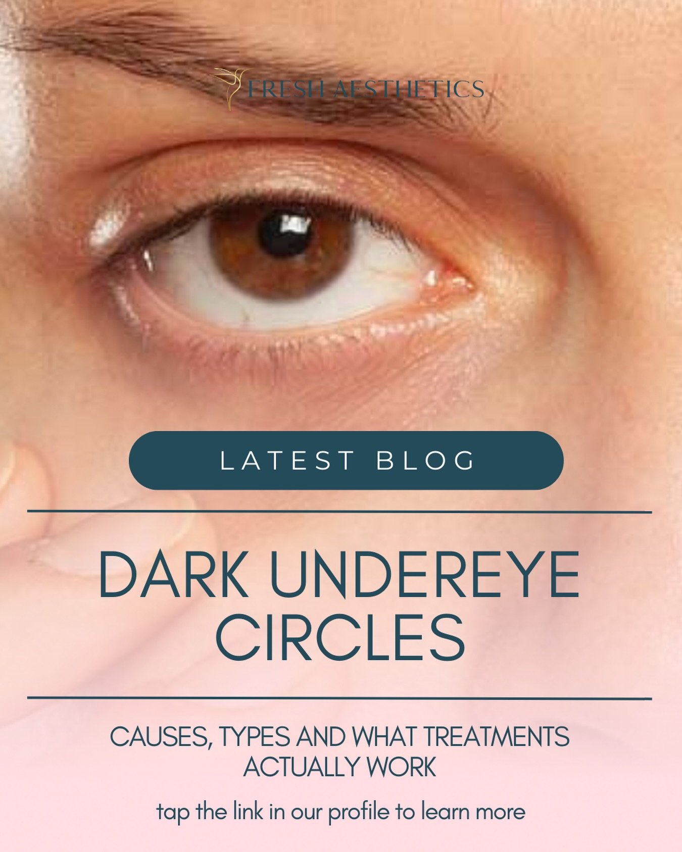 🔘Dark undereye circles are one of the commonest complaints we see in clinic. The treatment begins with the correct diagnosis, however there are numerous causes. Read our latest blog to find out what&rsquo;s causing yours &amp; how to treat them. Jus