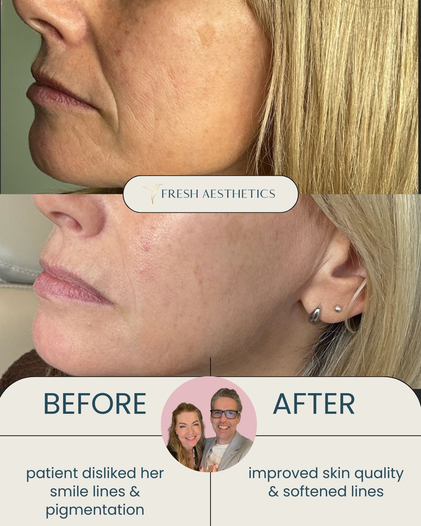 ⚜️These pics were taken a year apart. Our beautiful patient first came to us because she was bothered by her pigmentation, fine lines, lipstick lines &amp; deeper smile lines 

📍We began her aesthetic journey by starting her on a medical grade skinc