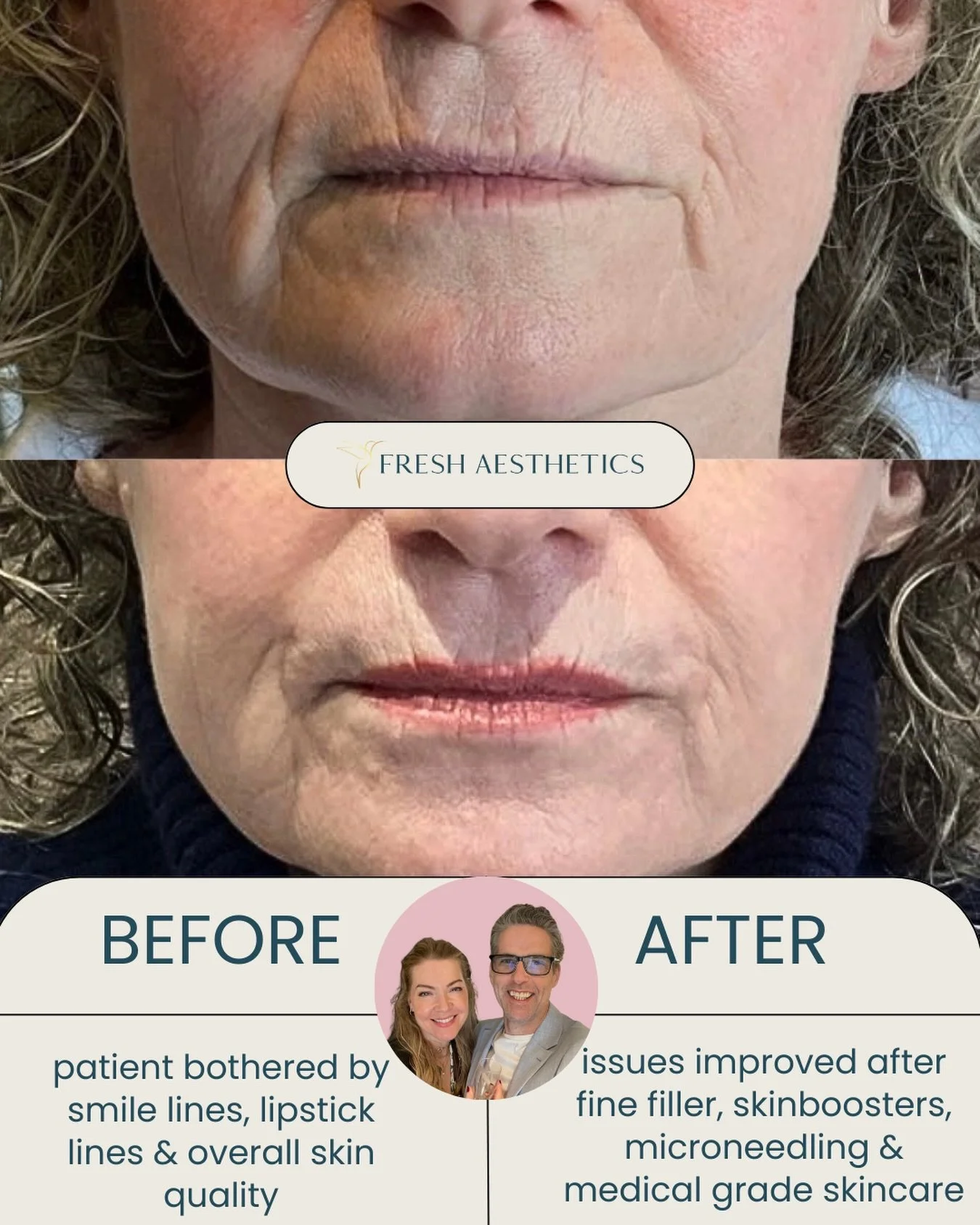 Our beautiful patient embarked on a journey with us last year. Her goal was to improve her overall skin quality &amp; soften the lines around her mouth 
 
Our first step was to start her on a medical grade skincare journey, starting with barrier repa