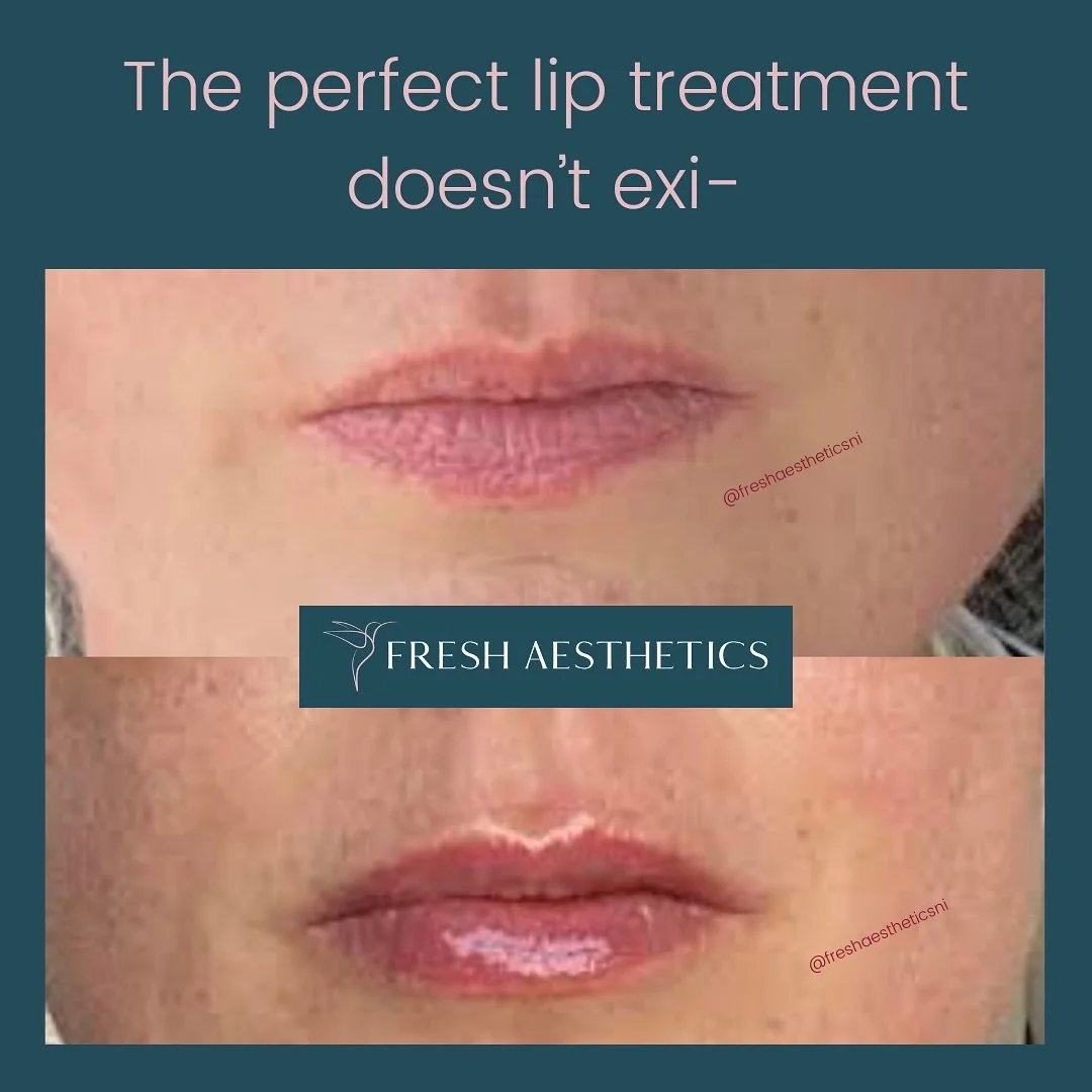 *takes a bow*

My patient and I were both so pleased at how well her  lip treatment turned out. In her words: &ldquo;I am totally  delighted with my results! So natural 👌 Keep looking in the mirror all chuffed with myself 😆"

Another one sayin