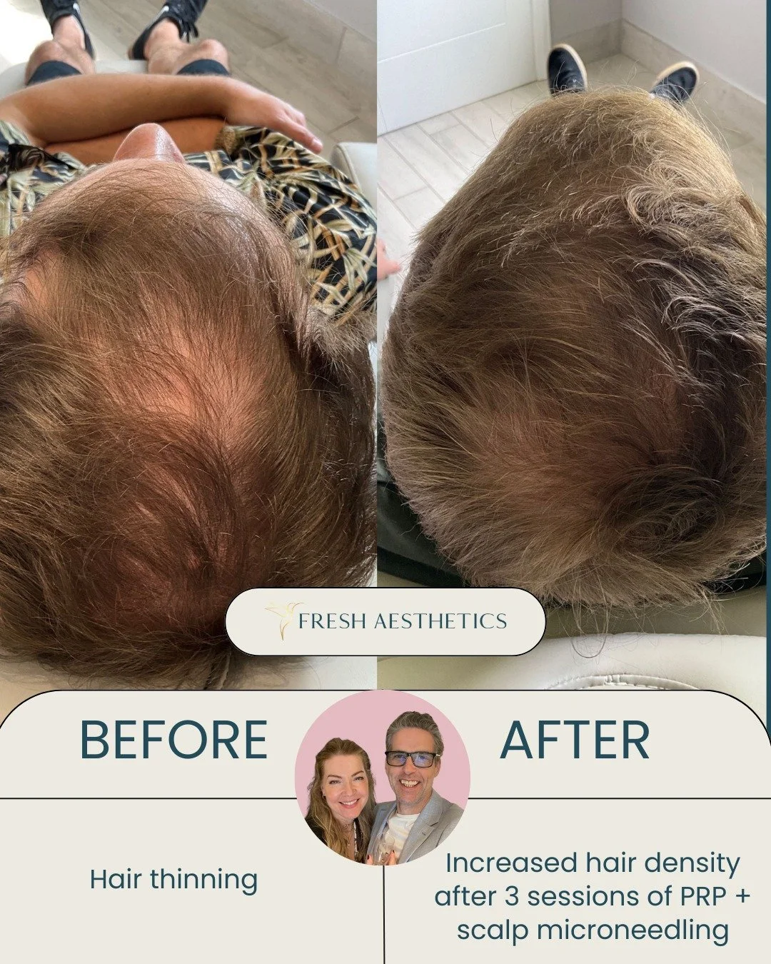 😃We were so delighted for our patient who had such a great response to our hair restoration treatment!

He had 3 sessions of scalp PRP, which included scalp microneedling using a hair restoration serum. This treatment can thicken existing hair as we