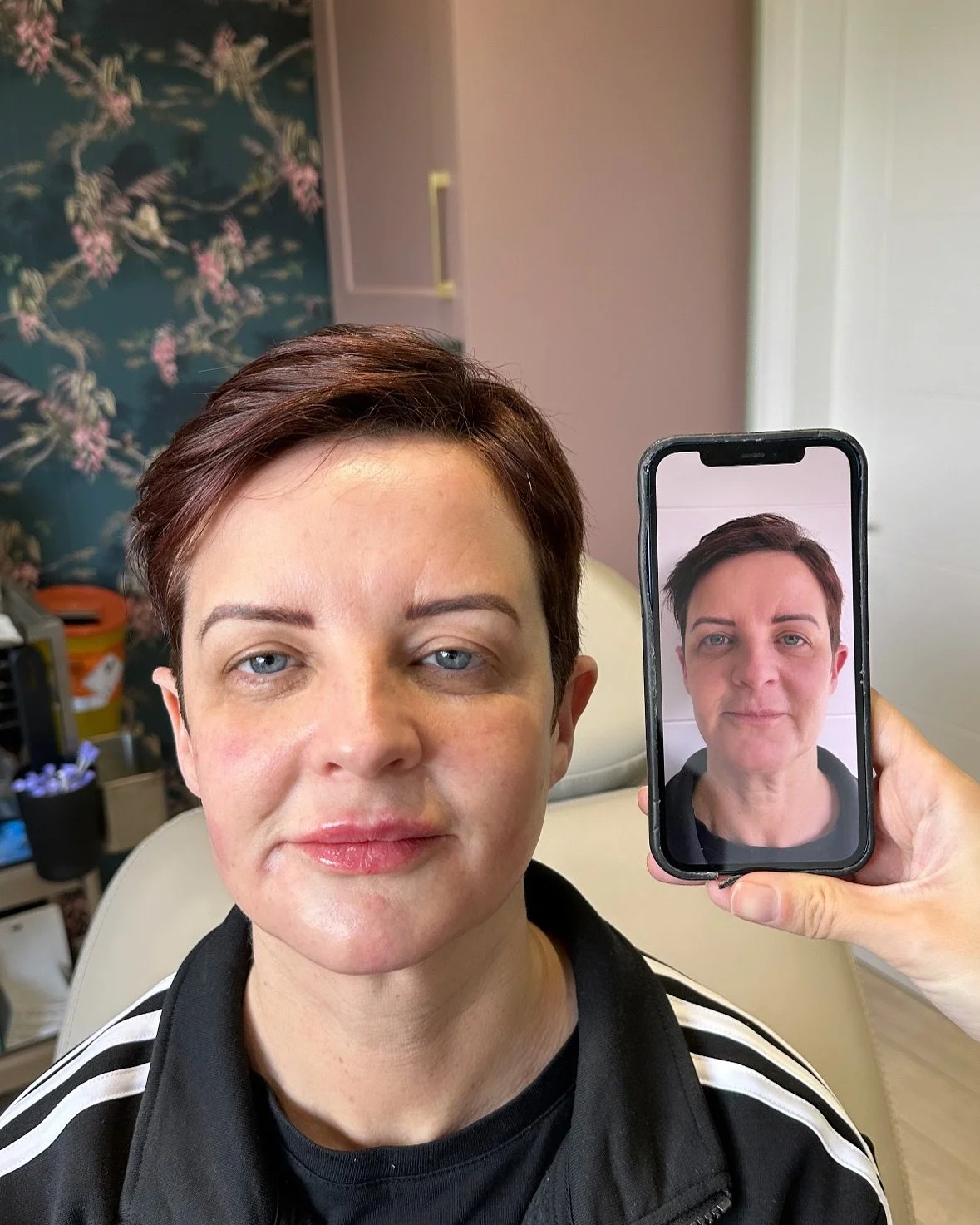 😘🤌This is why we LOVE doing a Full Face reFresh!! the smallest tweaks make the
biggest difference&hellip;

🥄Sprinkling a teaspoon of filler where our patients need it most: restoring lost volume, rebalancing facial features, softening fine lines, 